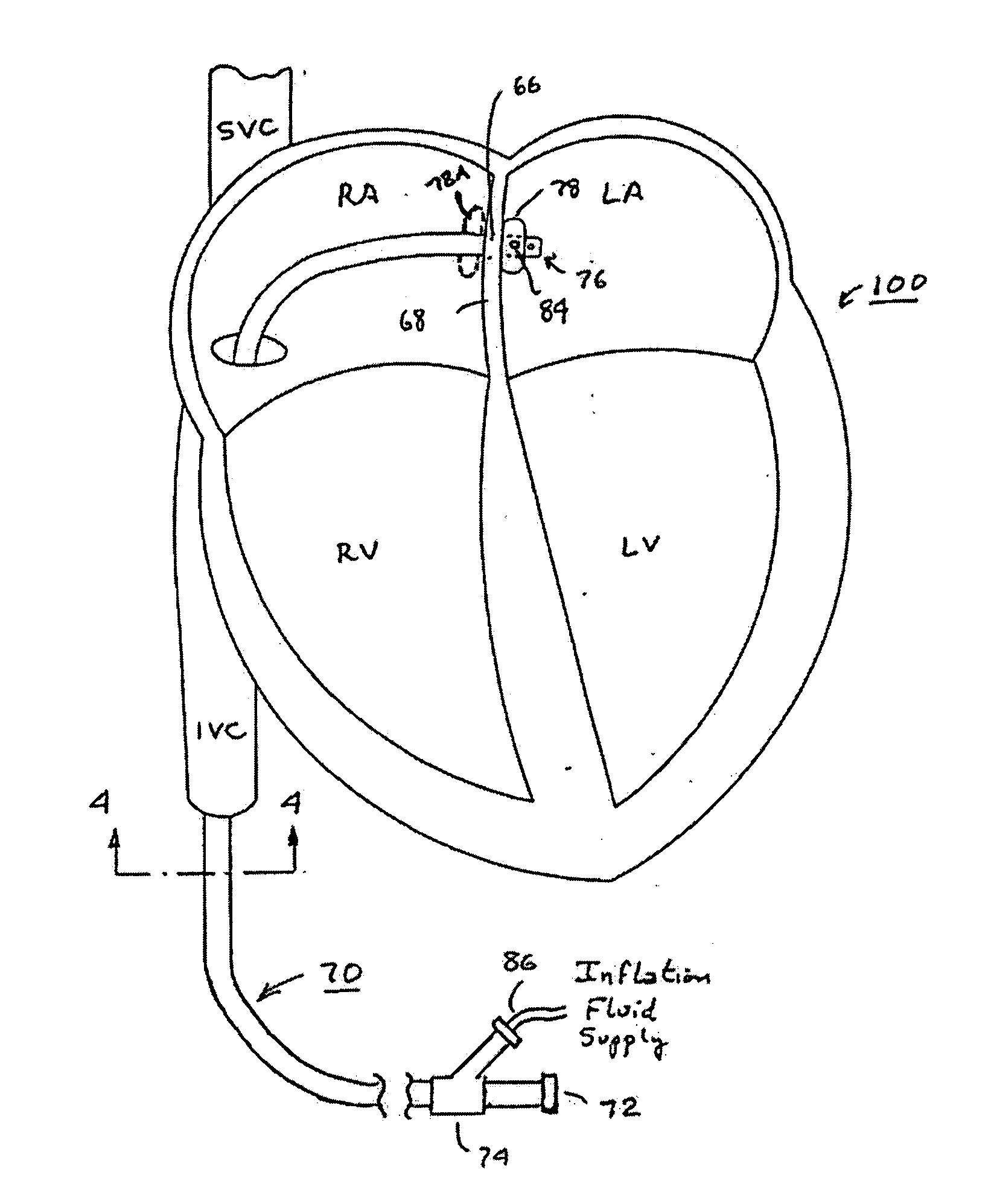 Trans-septal catheter with retention mechanism