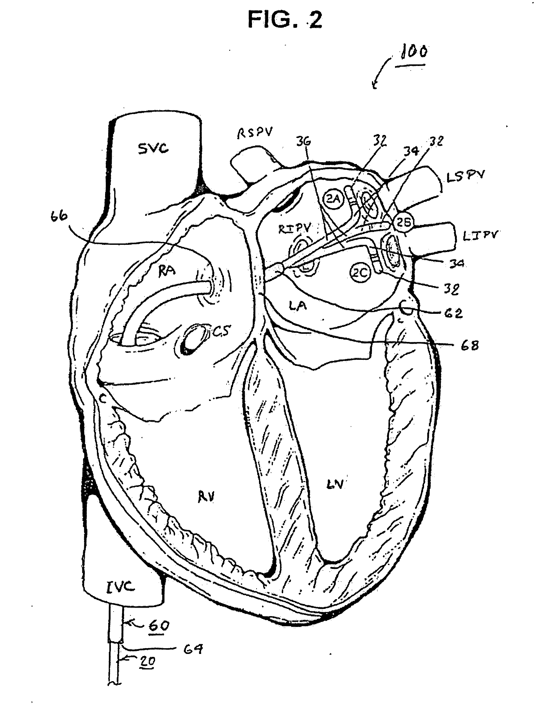 Trans-septal catheter with retention mechanism