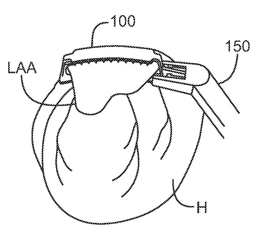 Left atrial appendage devices and methods