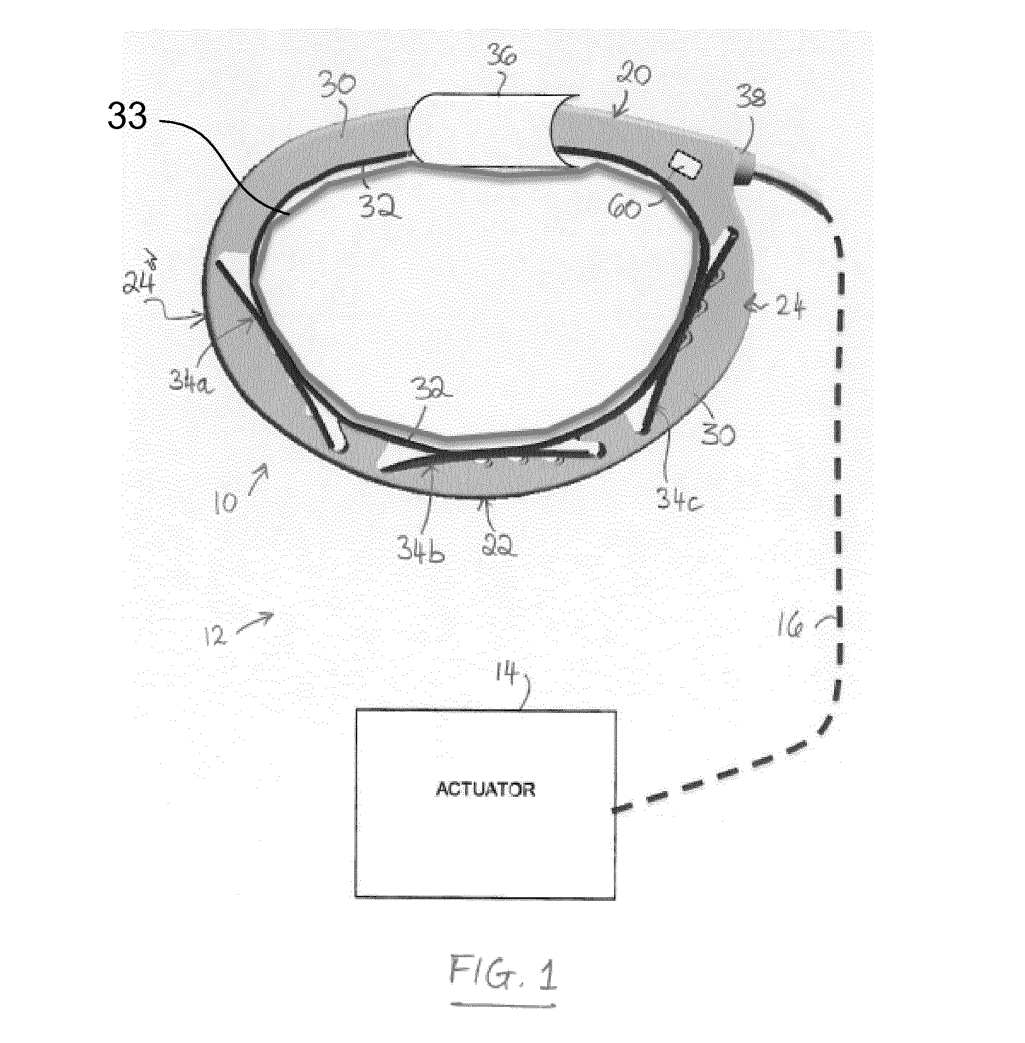 Adjustable annuloplasty ring and system