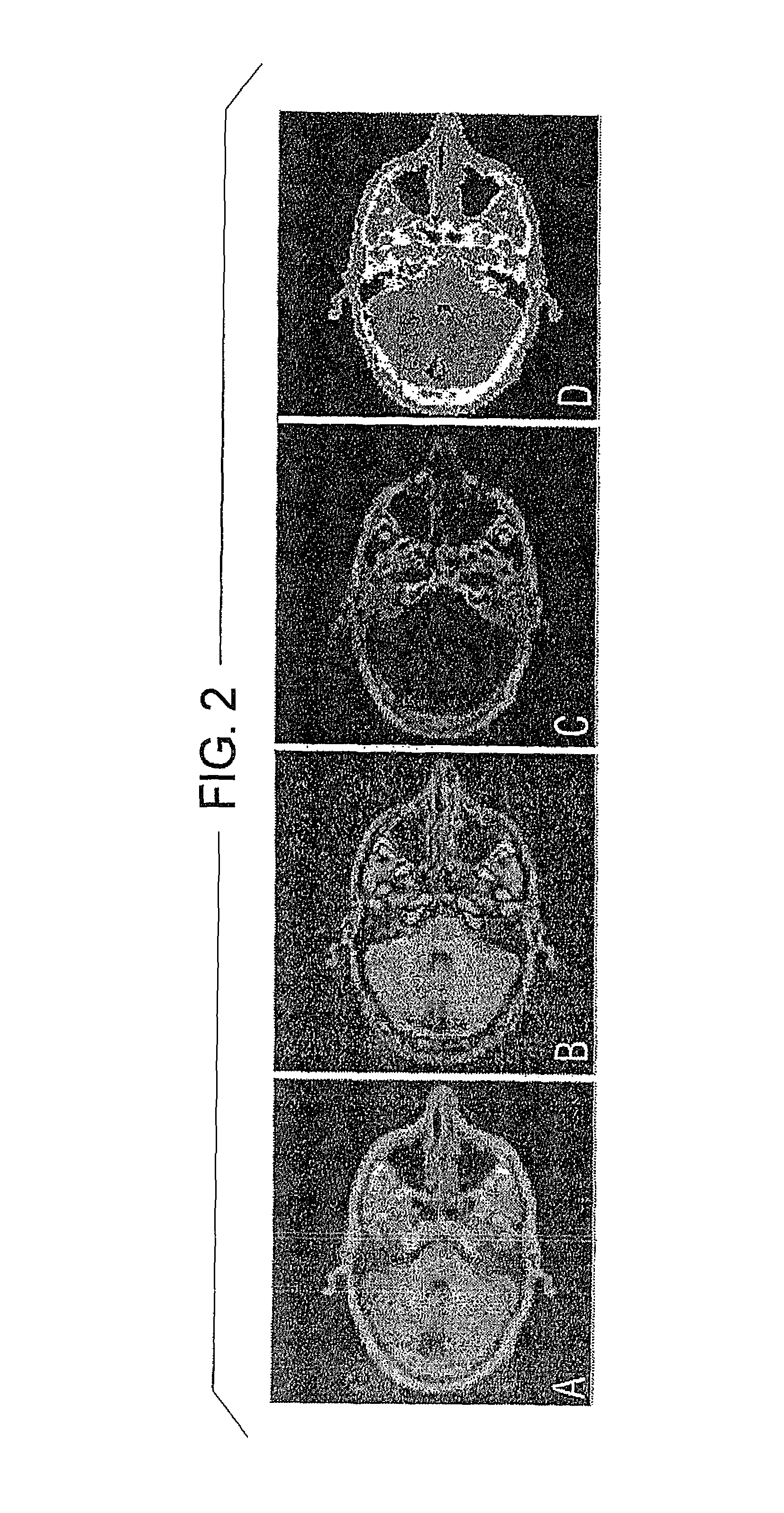 Magnetic resonance method and apparatus for automatically determining objects that attenuate penetrating radiation