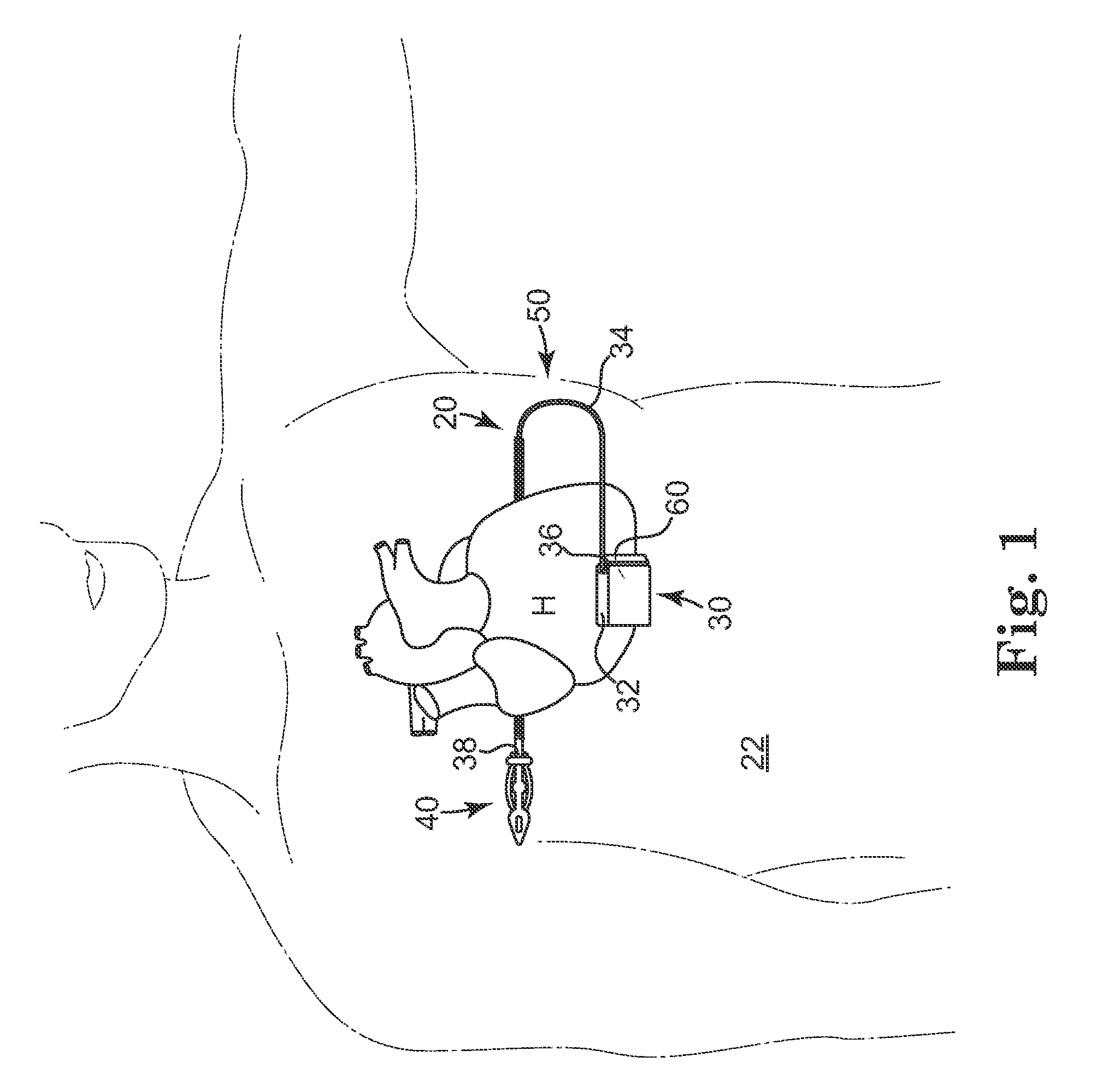 Subcutaneously implantable lead including distal fixation mechanism