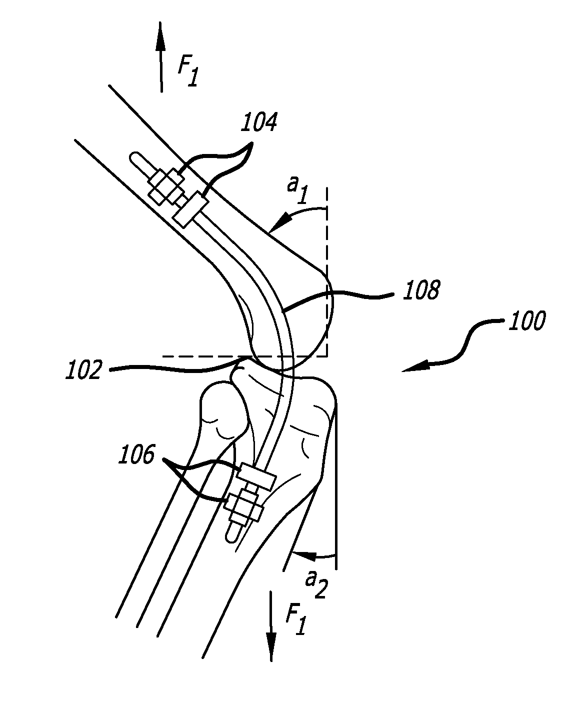 Extra-Articular Implantable Mechanical Energy Absorbing Systems