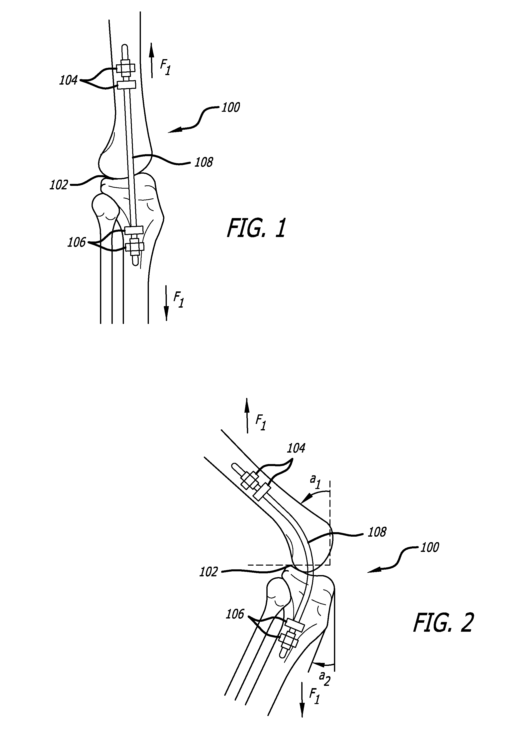 Extra-Articular Implantable Mechanical Energy Absorbing Systems