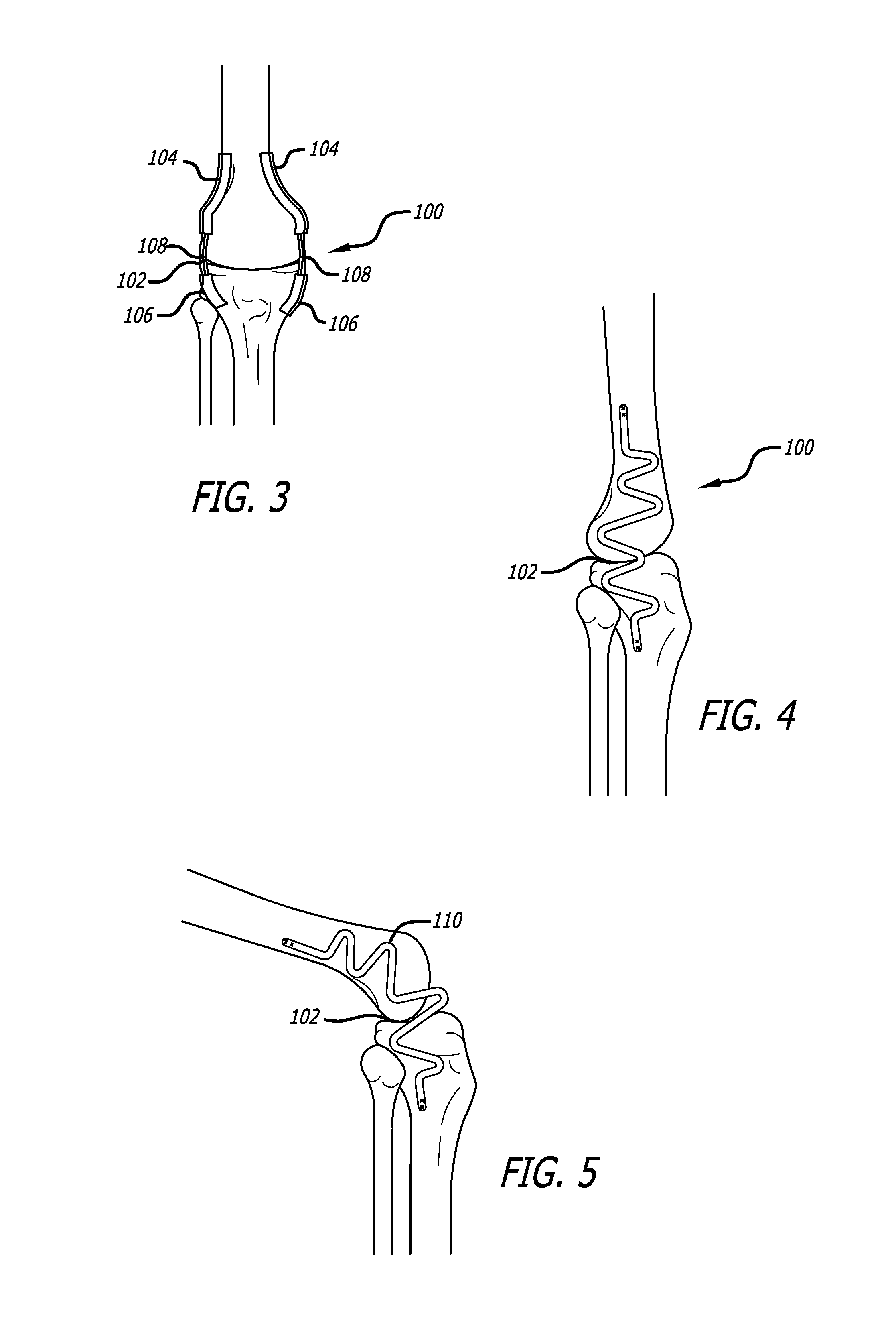 Extra-Articular Implantable Mechanical Energy Absorbing Systems