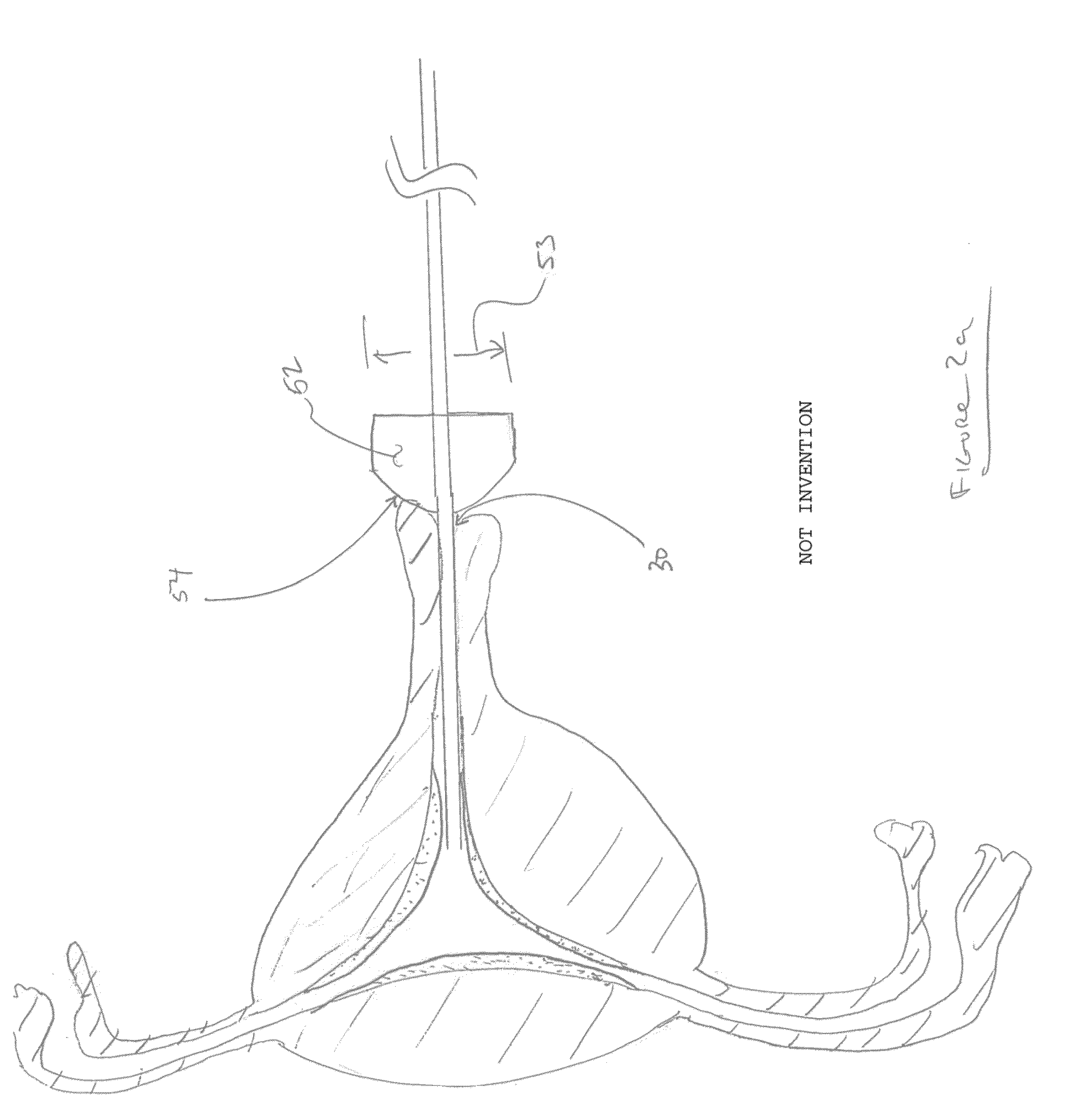 Biopsy and sonography method and apparatus for assessing bodily cavities