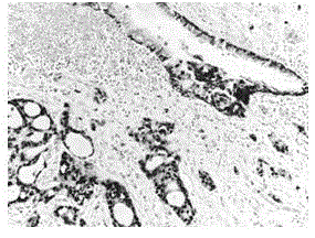 Histological classification immunohistochemical multiple staining detection method for lung cancer