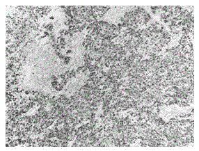 Histological classification immunohistochemical multiple staining detection method for lung cancer