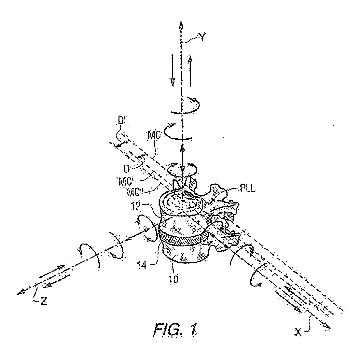 Methods and apparatus for spinal reconstructive surgery and measuring spinal length and intervertebral spacing, tension and rotation