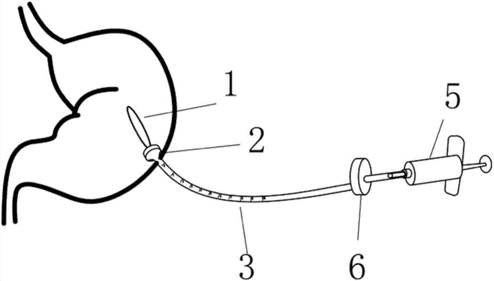 Percutaneous endoscopic gastrostomy gastric airbag implantation device