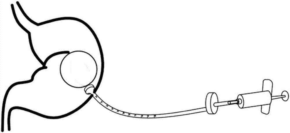 Percutaneous endoscopic gastrostomy gastric airbag implantation device