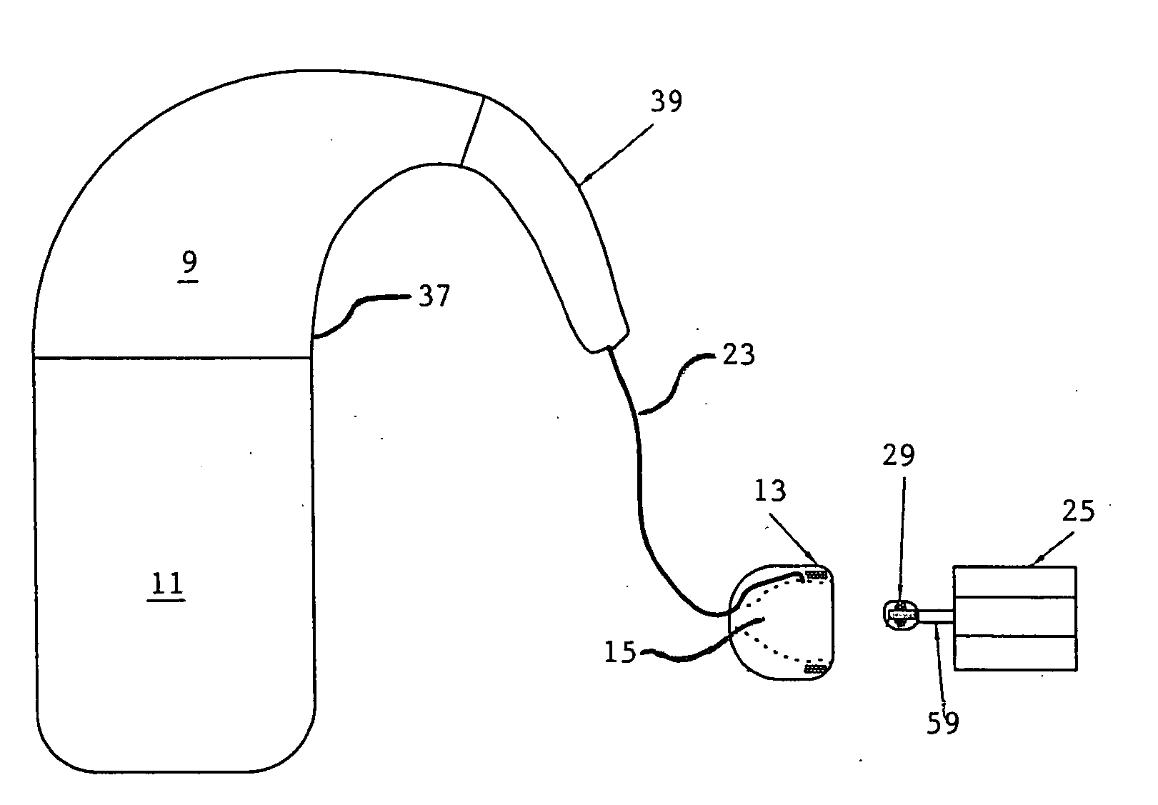 Cochlear ear implant