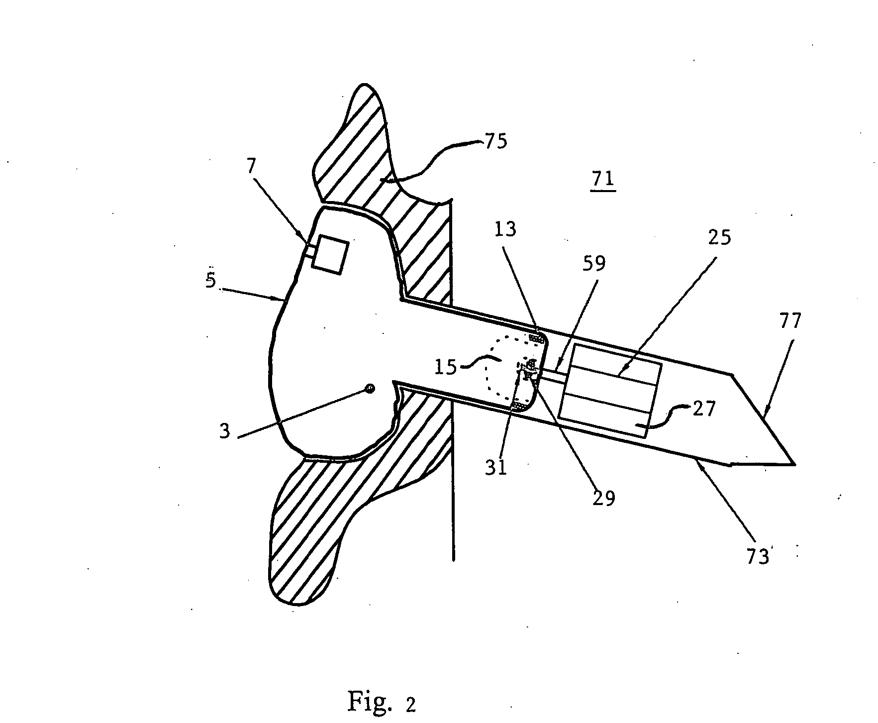 Cochlear ear implant