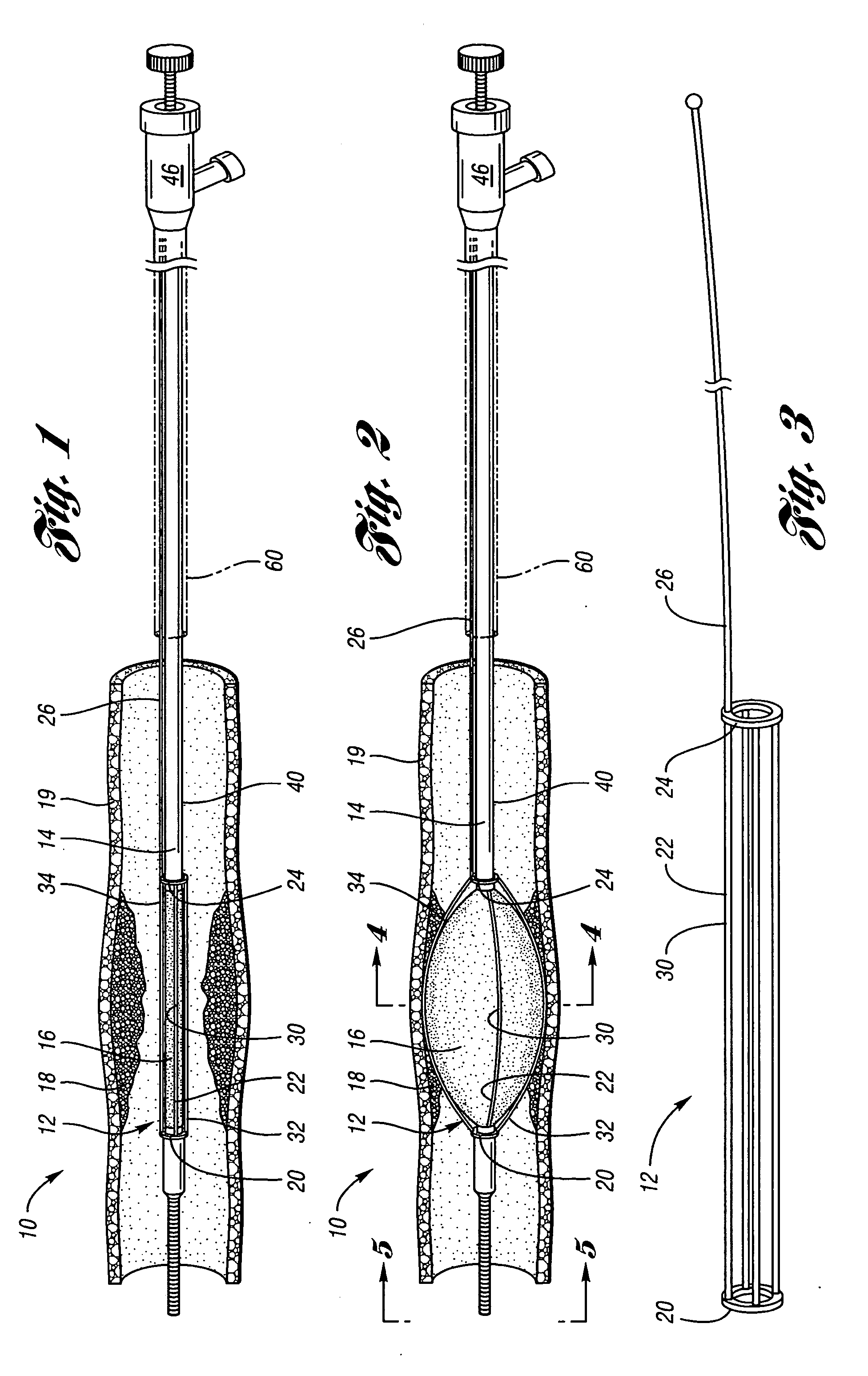 Angioplasty cutting device and method for treating a stenotic lesion in a body vessel