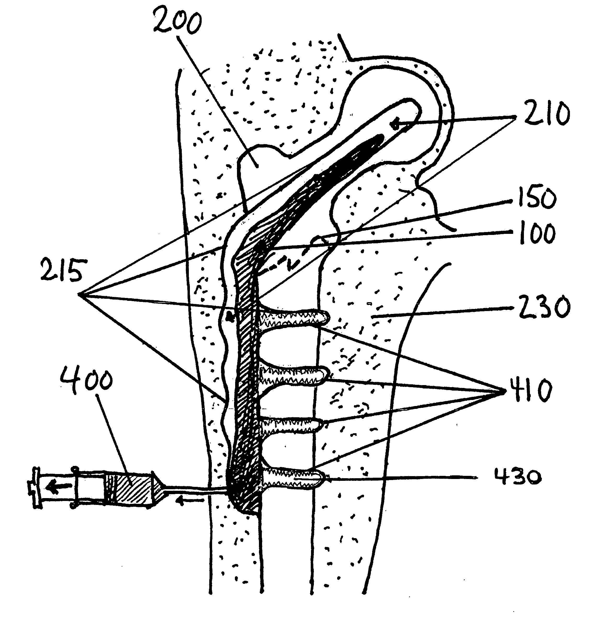 Material for surgical use in traumatology