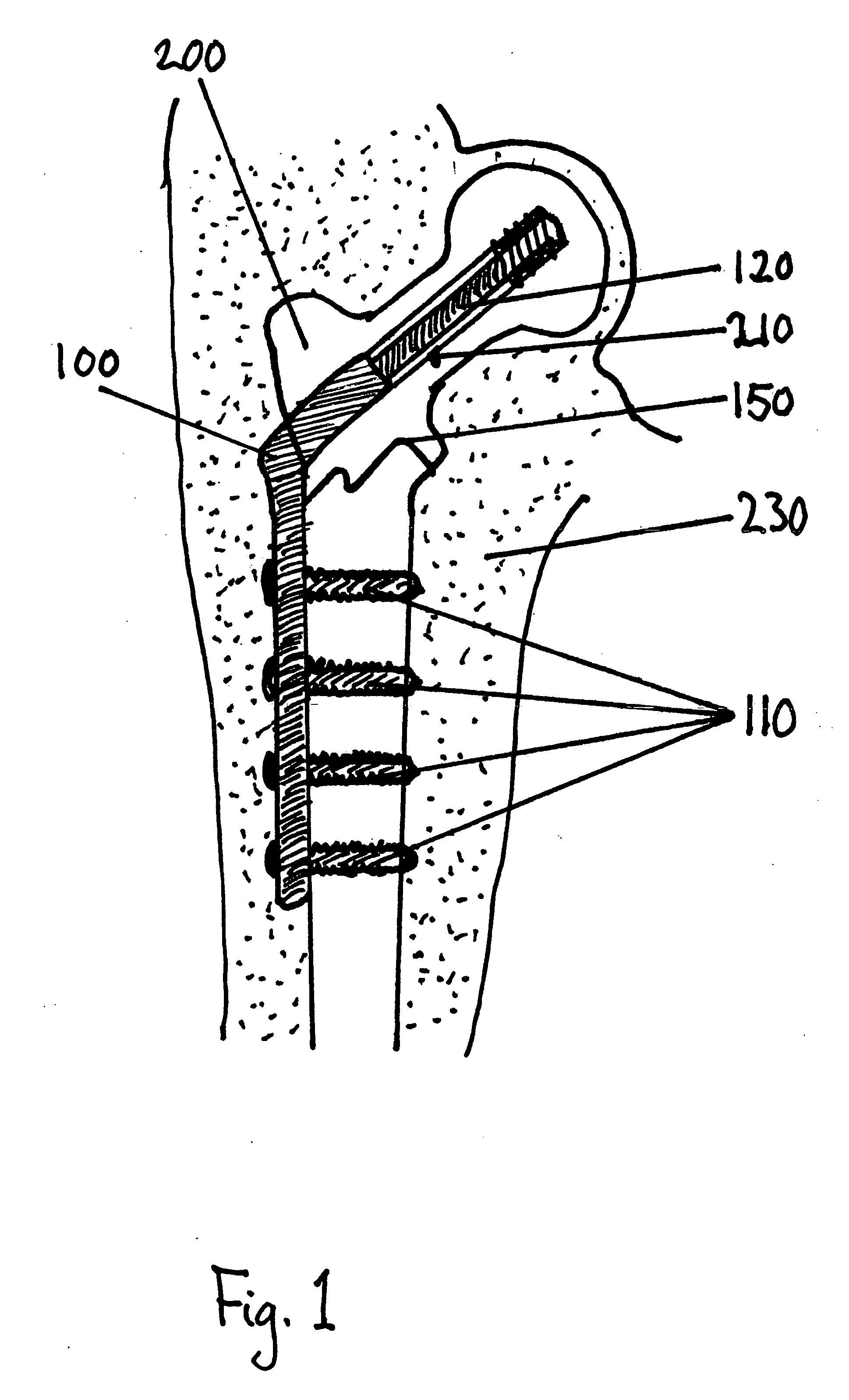 Material for surgical use in traumatology