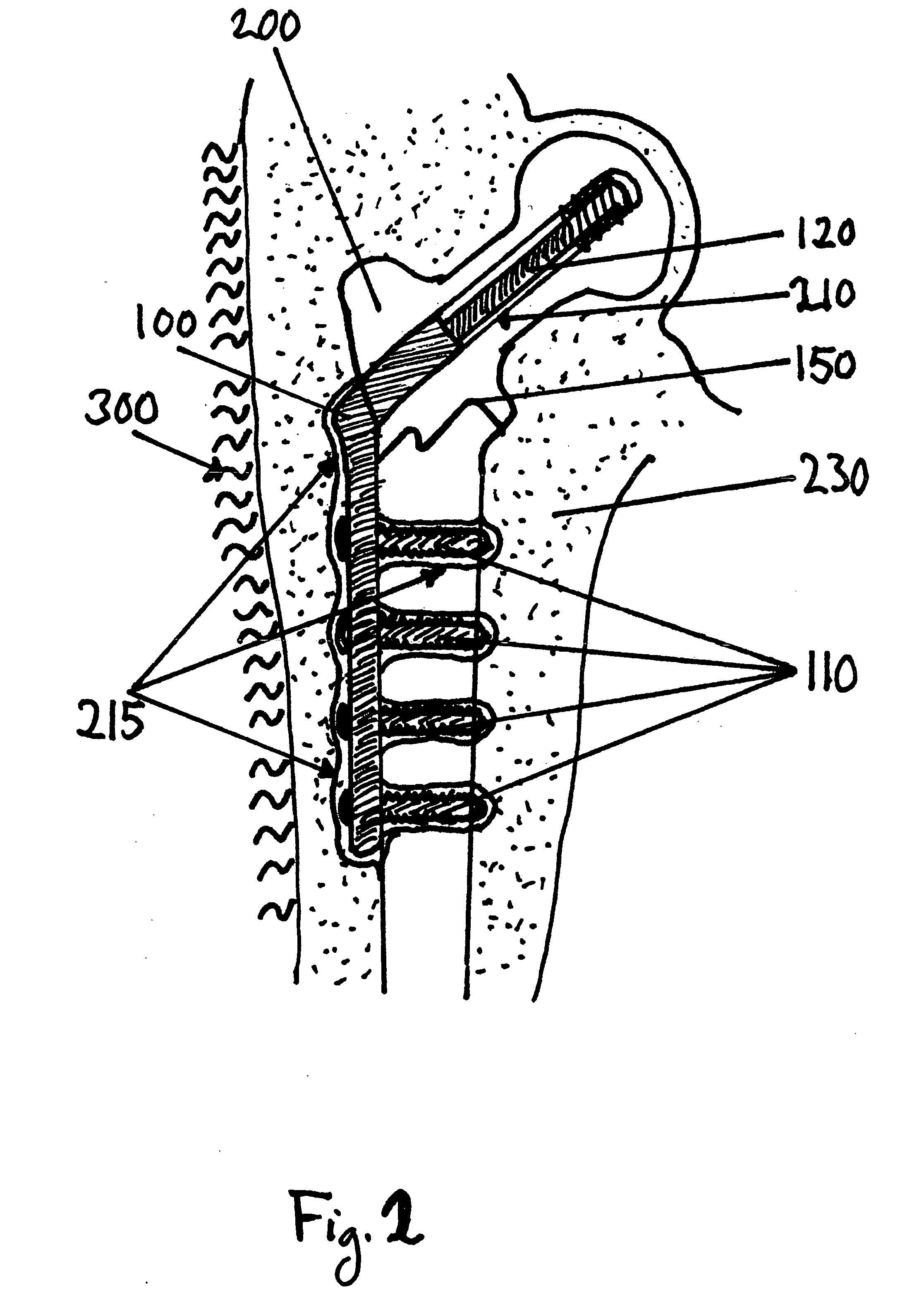 Material for surgical use in traumatology