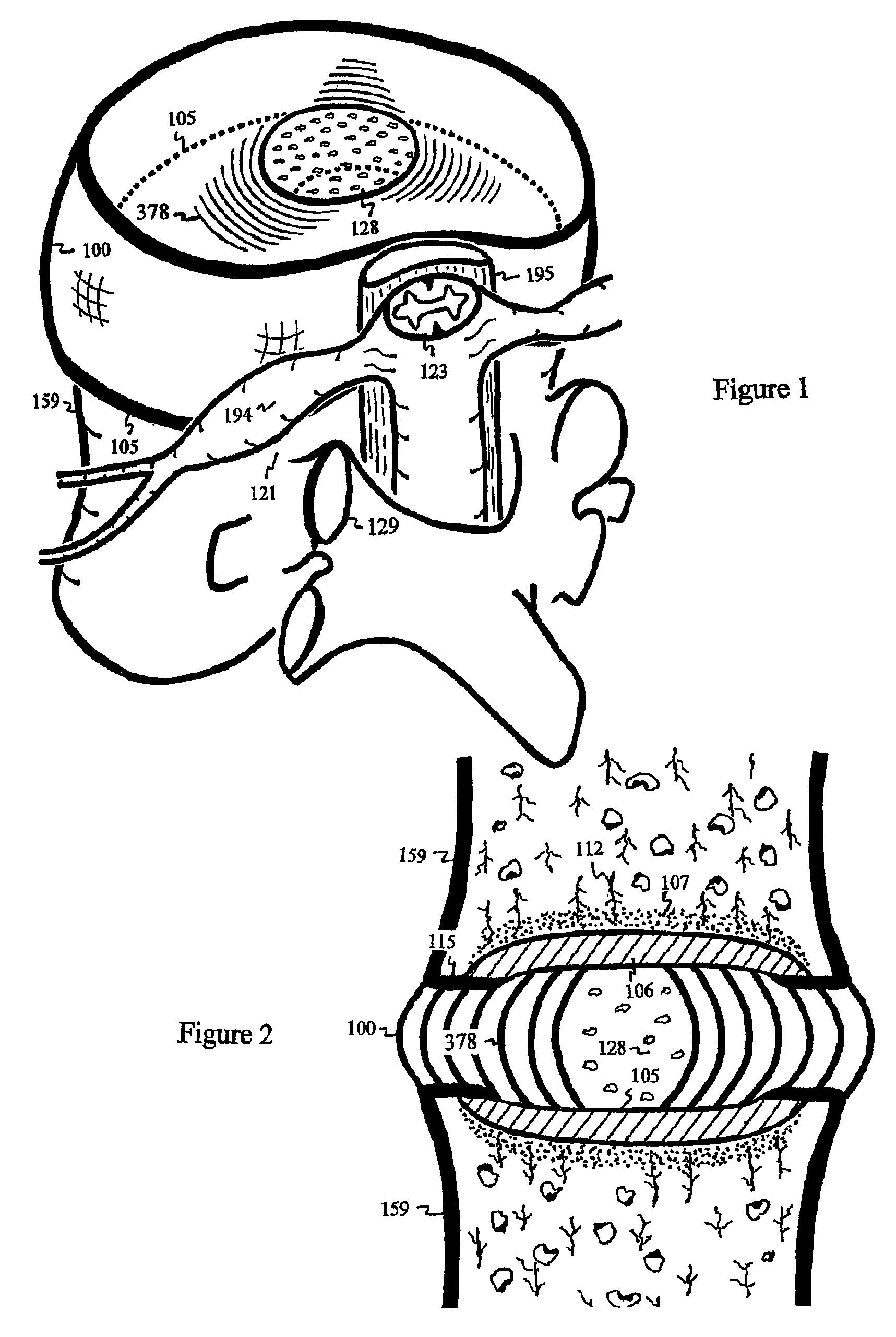 Alleviate back pain by increasing pH of the disc