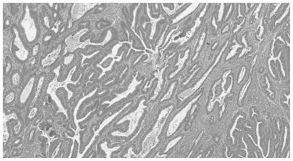 Tumor interstitial ratio judgment method and system based on image processing algorithm