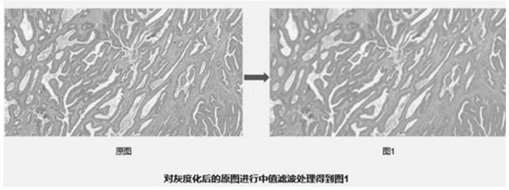 Tumor interstitial ratio judgment method and system based on image processing algorithm