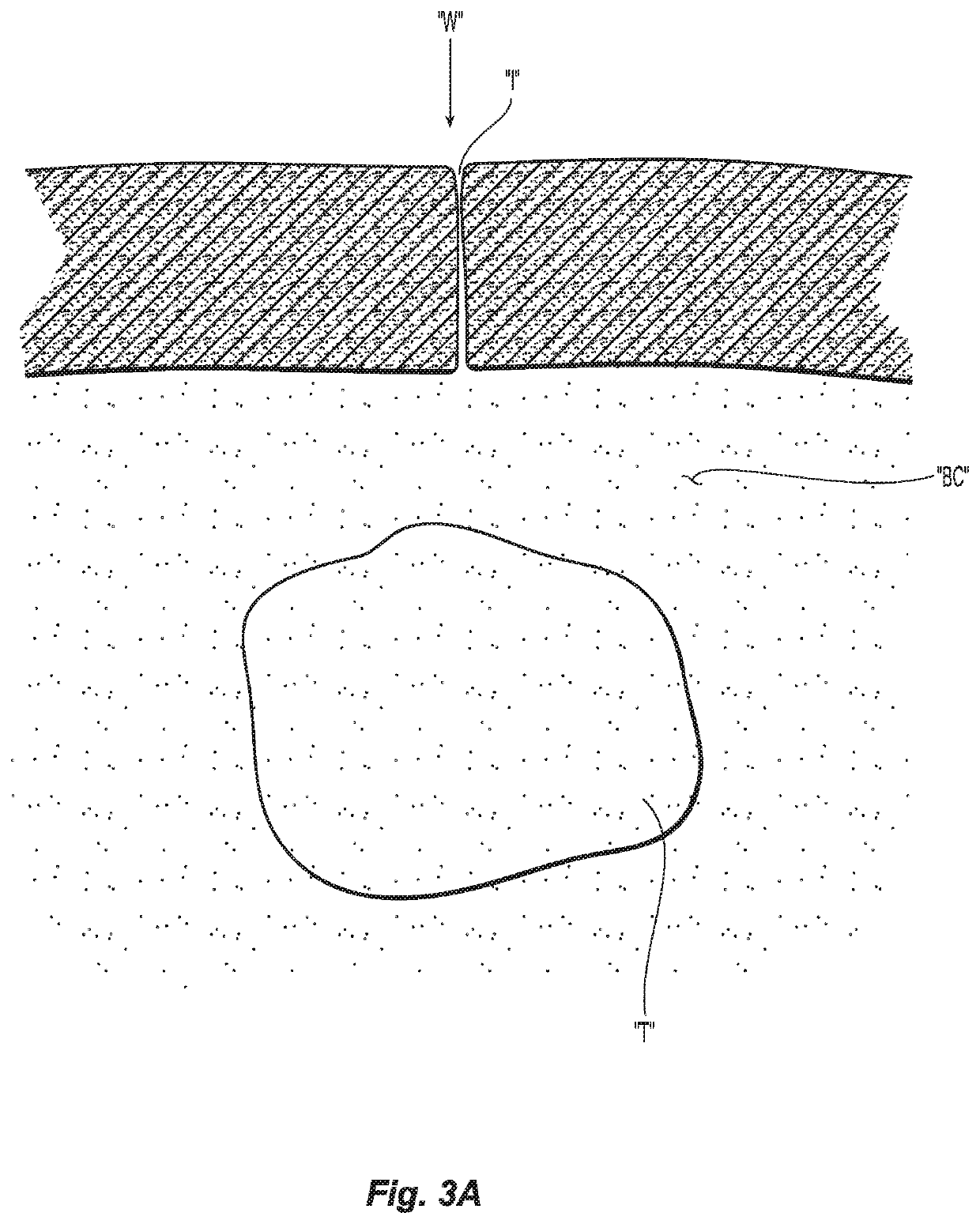 Cutting guard with radiofrequency dissection