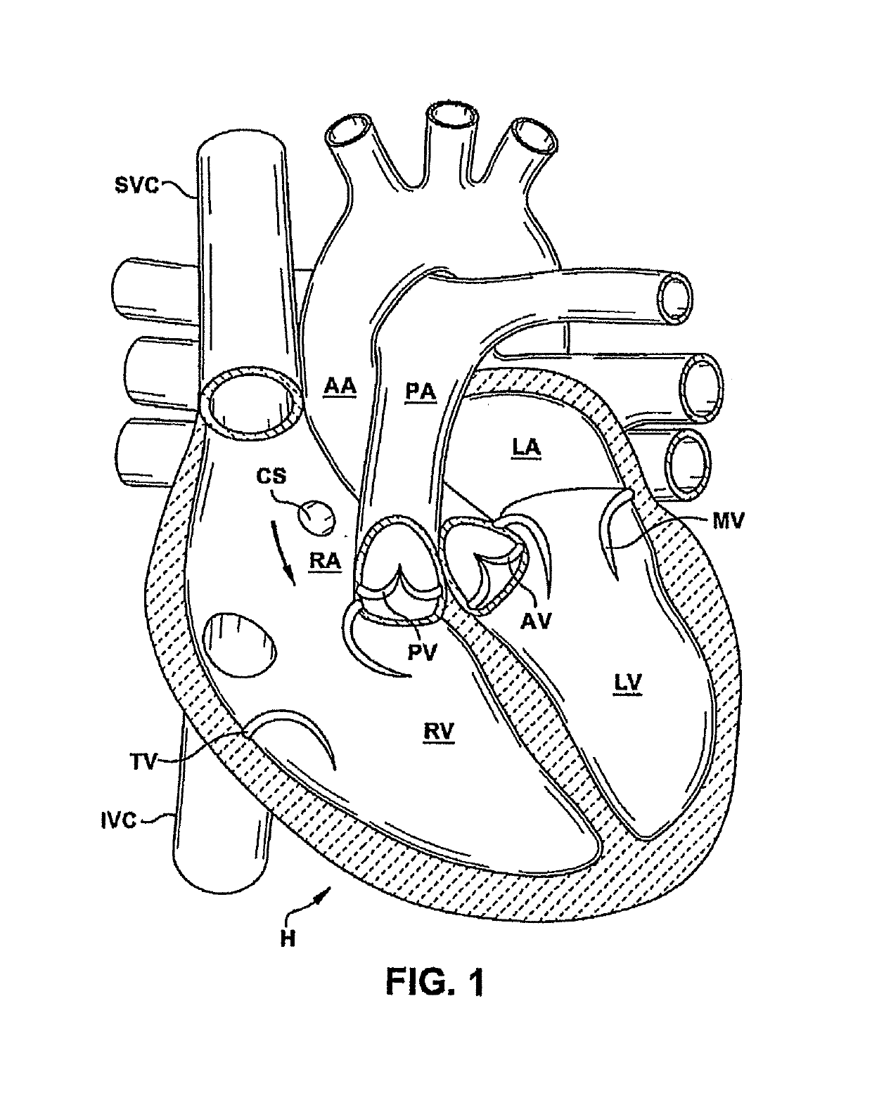 Heart valve sealing devices and delivery devices therefor