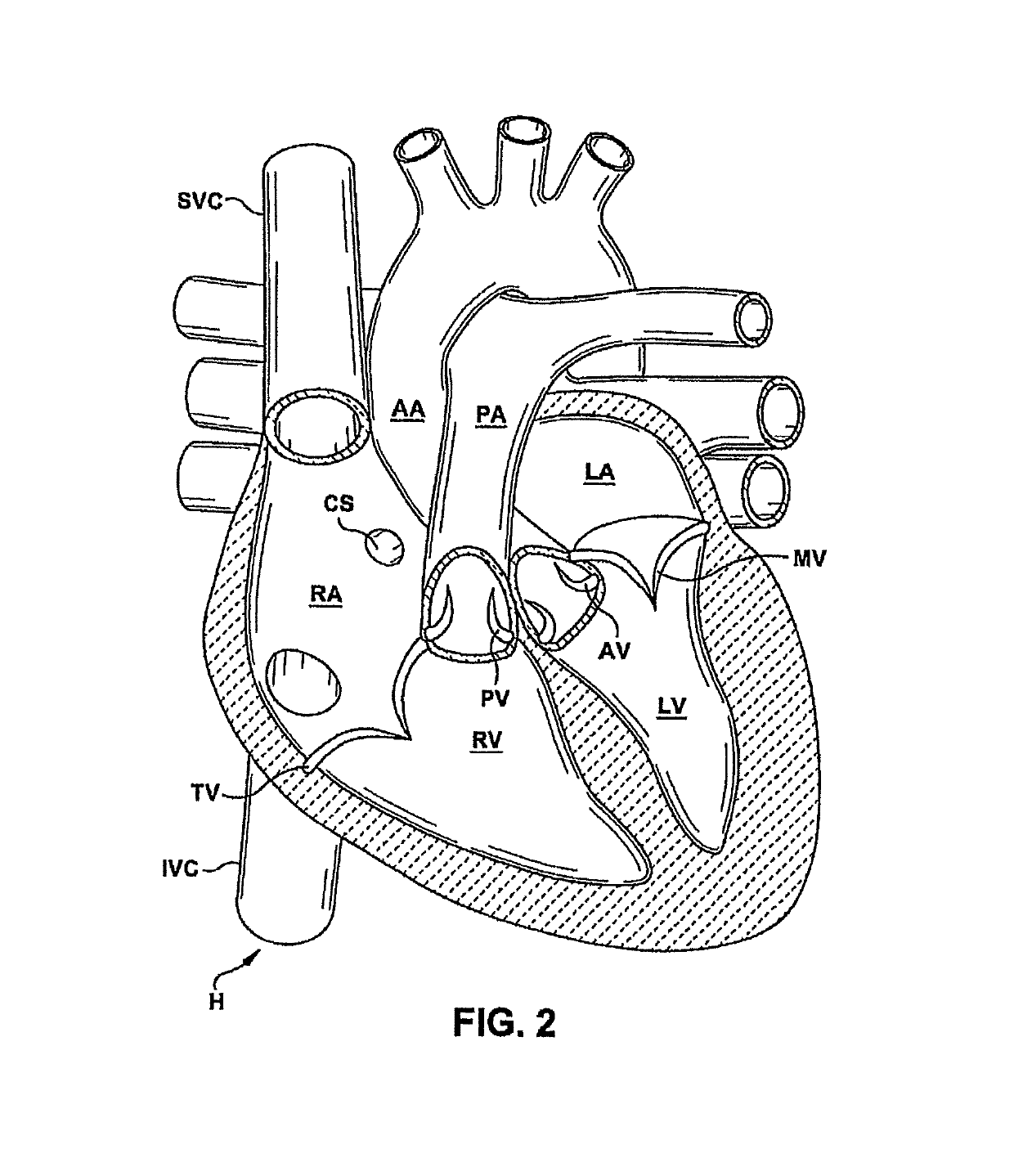 Heart valve sealing devices and delivery devices therefor