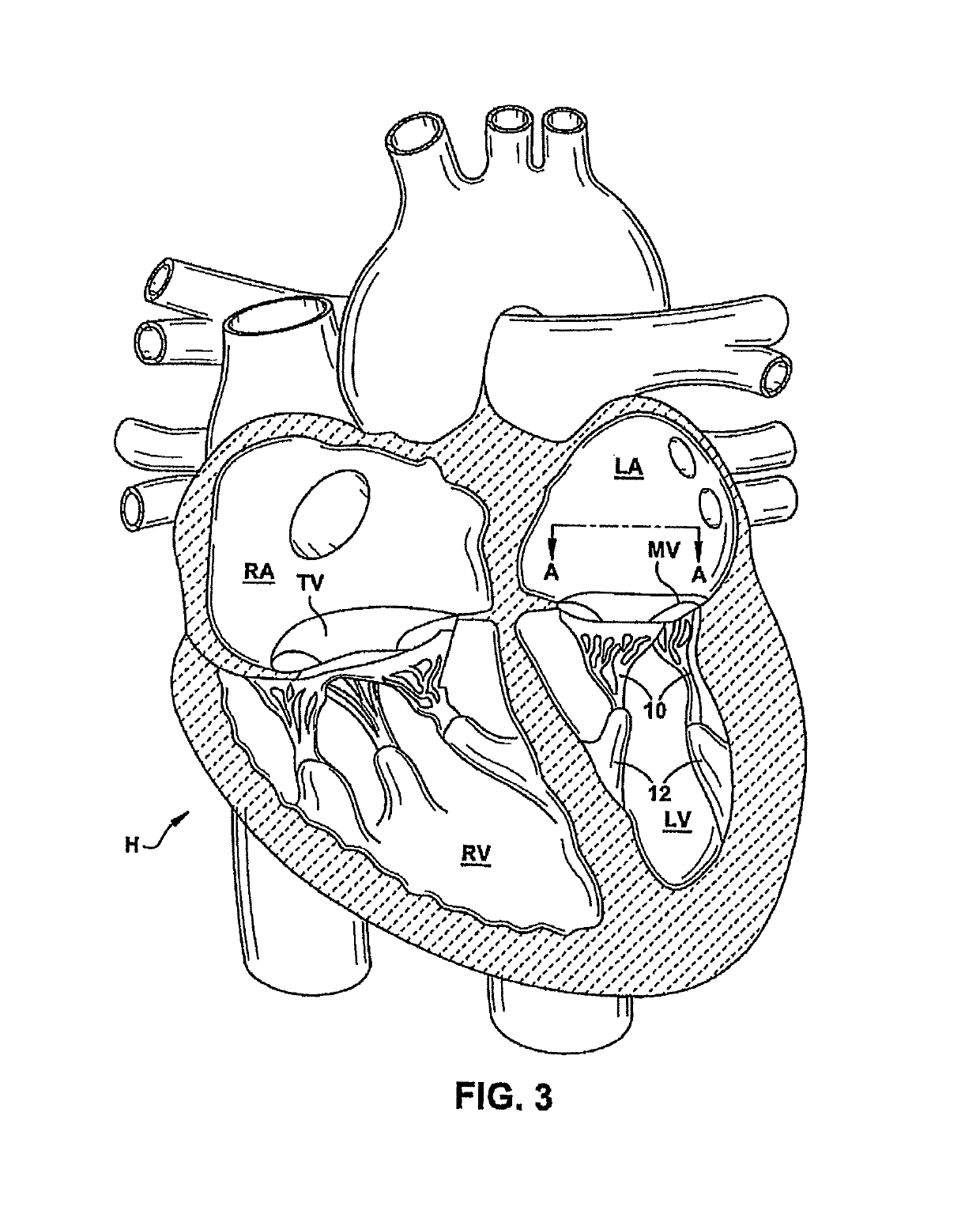 Heart valve sealing devices and delivery devices therefor