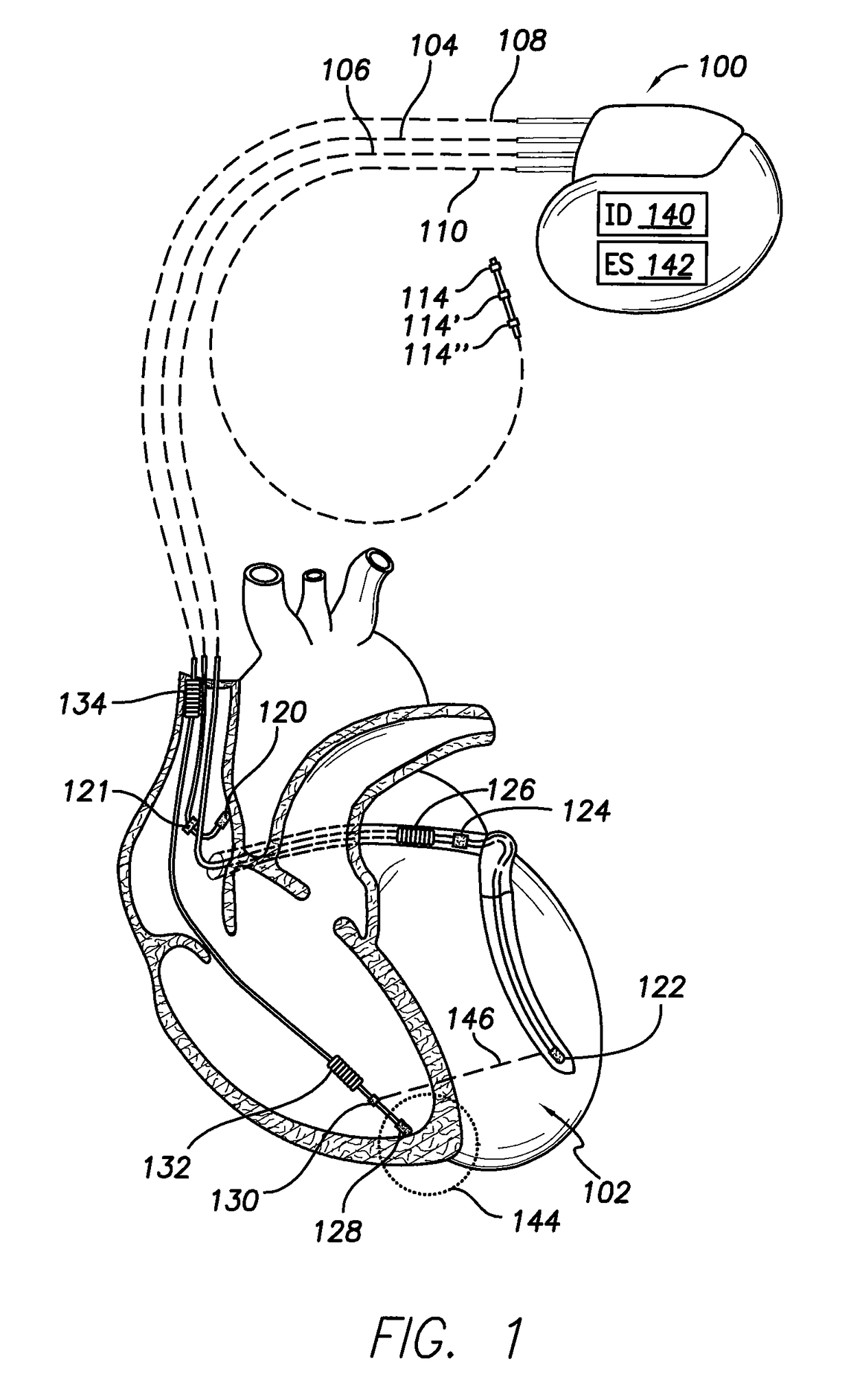 Considering cardiac ischemia in electrode selection