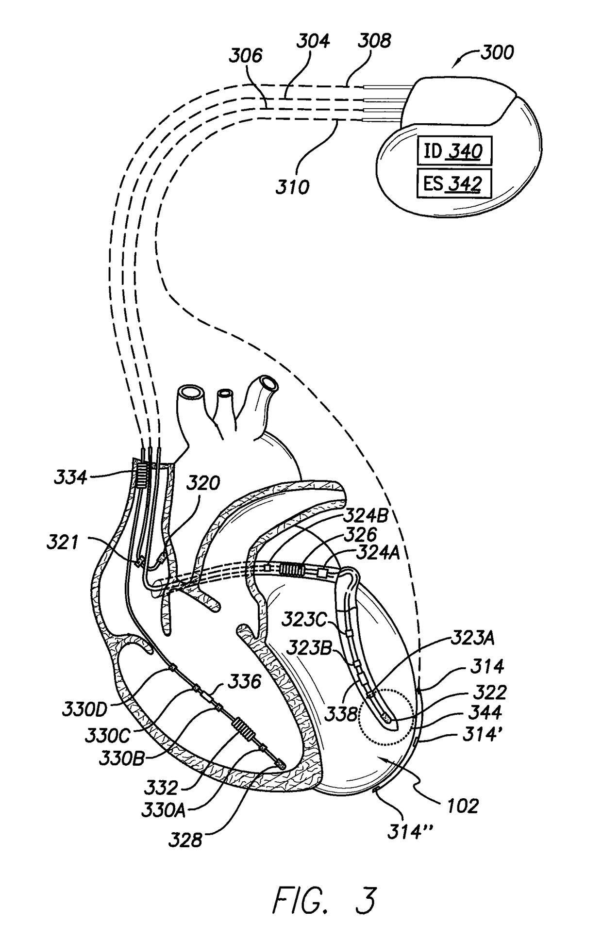 Considering cardiac ischemia in electrode selection