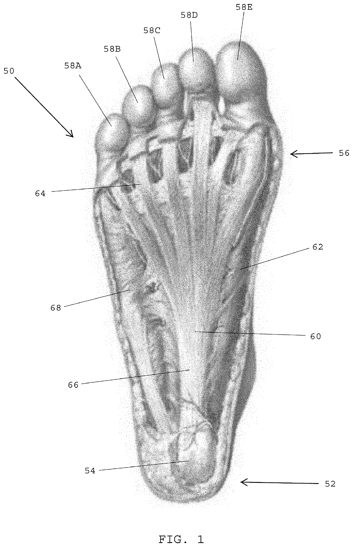 Systems, devices, and non-invasive surgical methods for treating plantar fasciitis and chronic heel spur syndrome