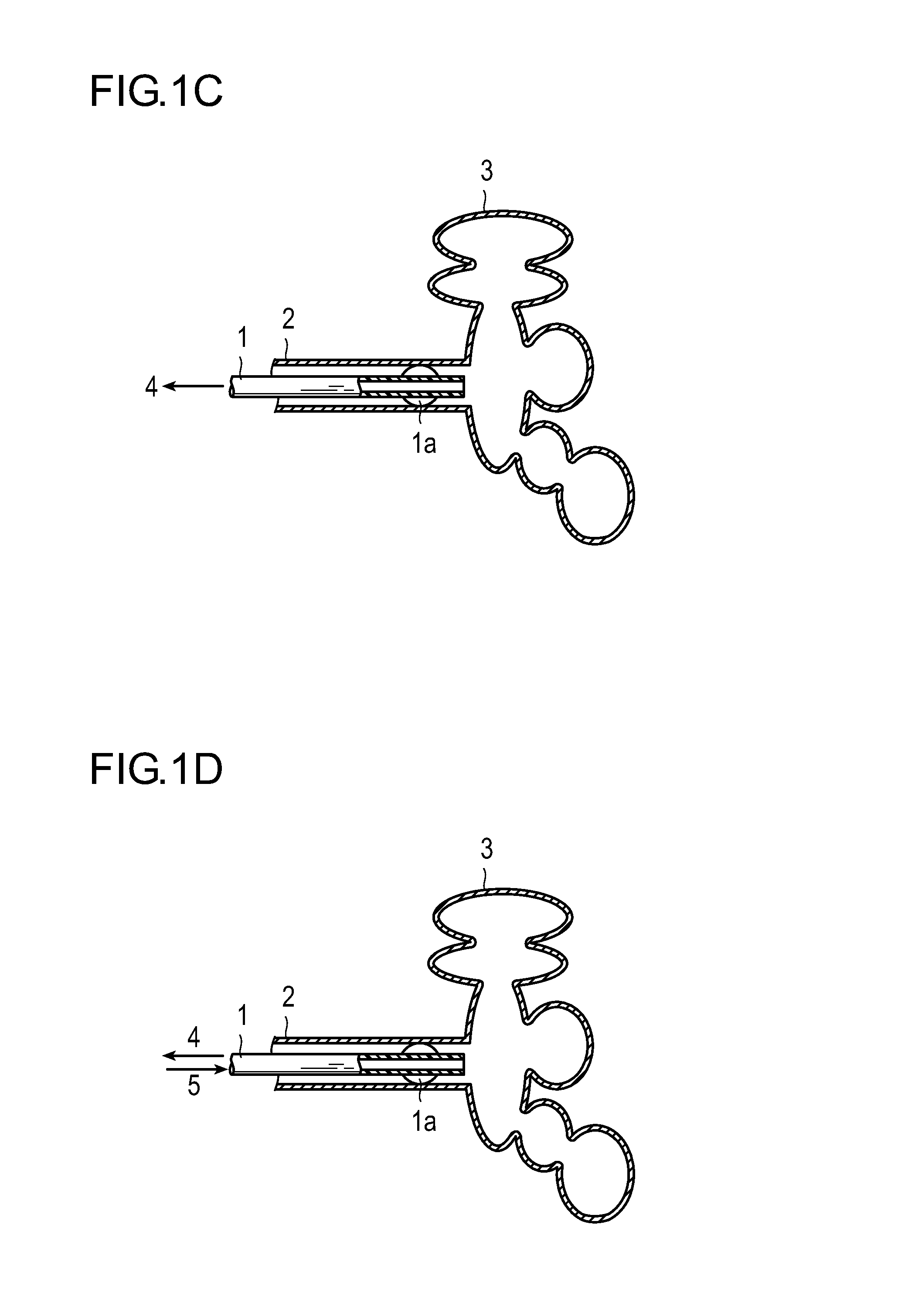 Method for treatment of emphysema