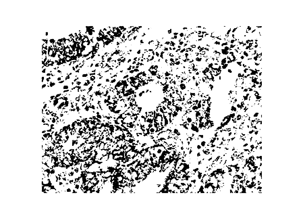 Application of SMOC2 gene in preparation of medicine for detecting or treating endometrial cancer and ovarian cancer