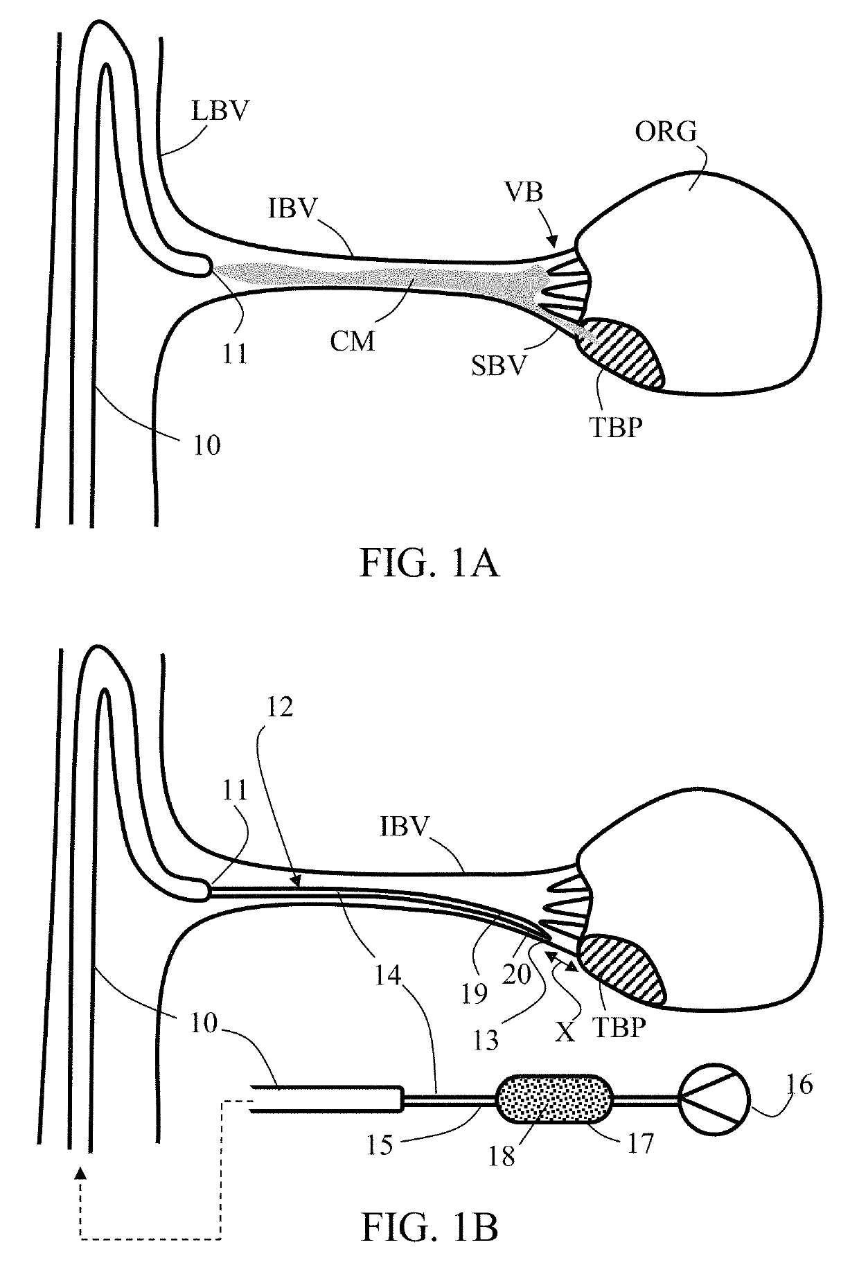 Embolization microcatheter