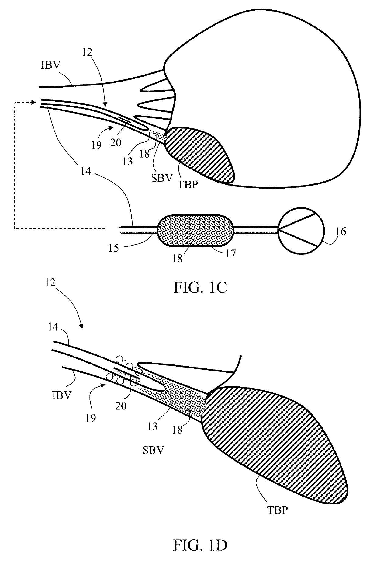 Embolization microcatheter