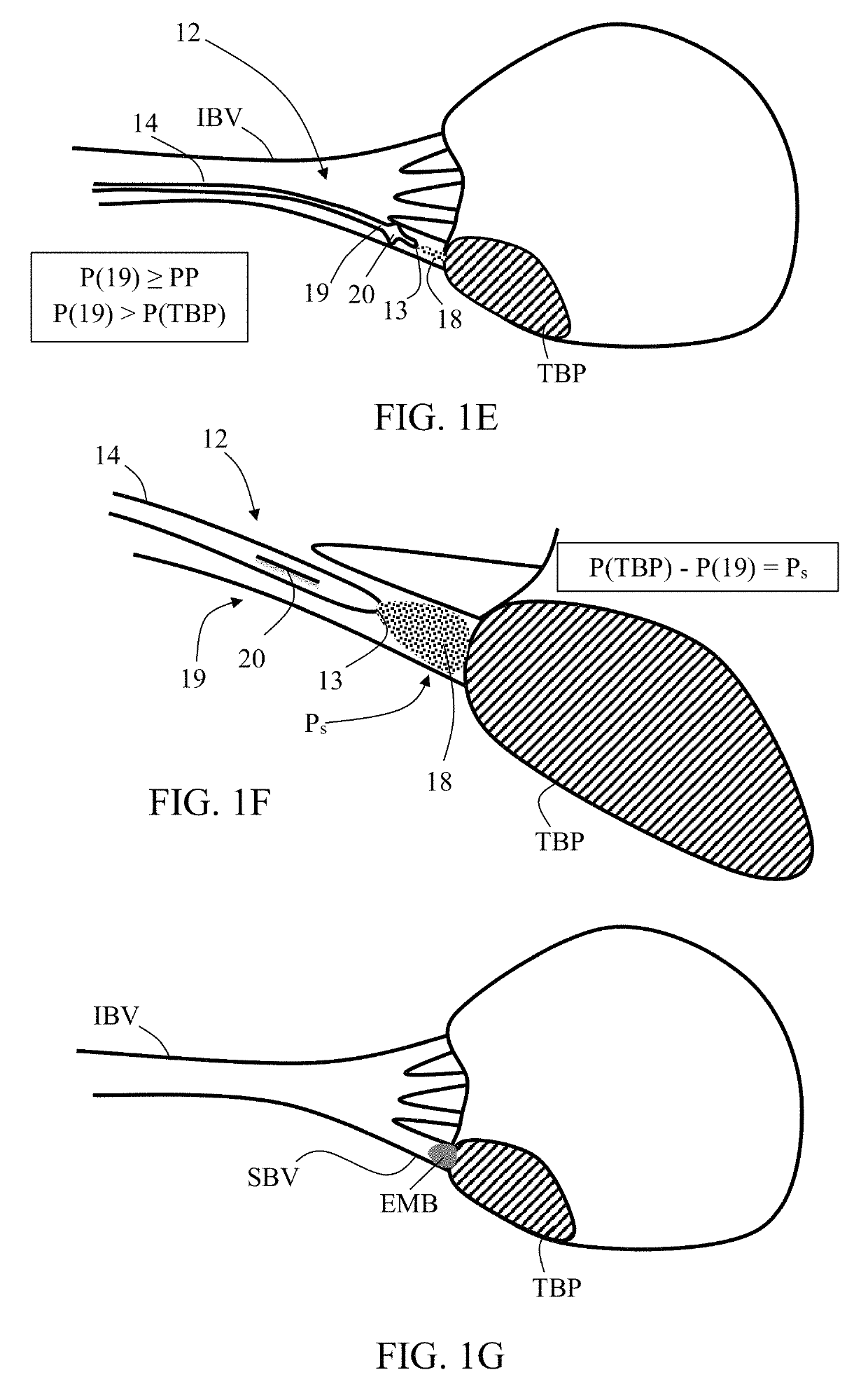 Embolization microcatheter