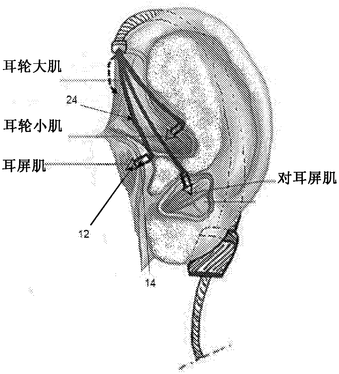 Electro-stimulation device effective in muscle location identification and therapeutic response enhancement