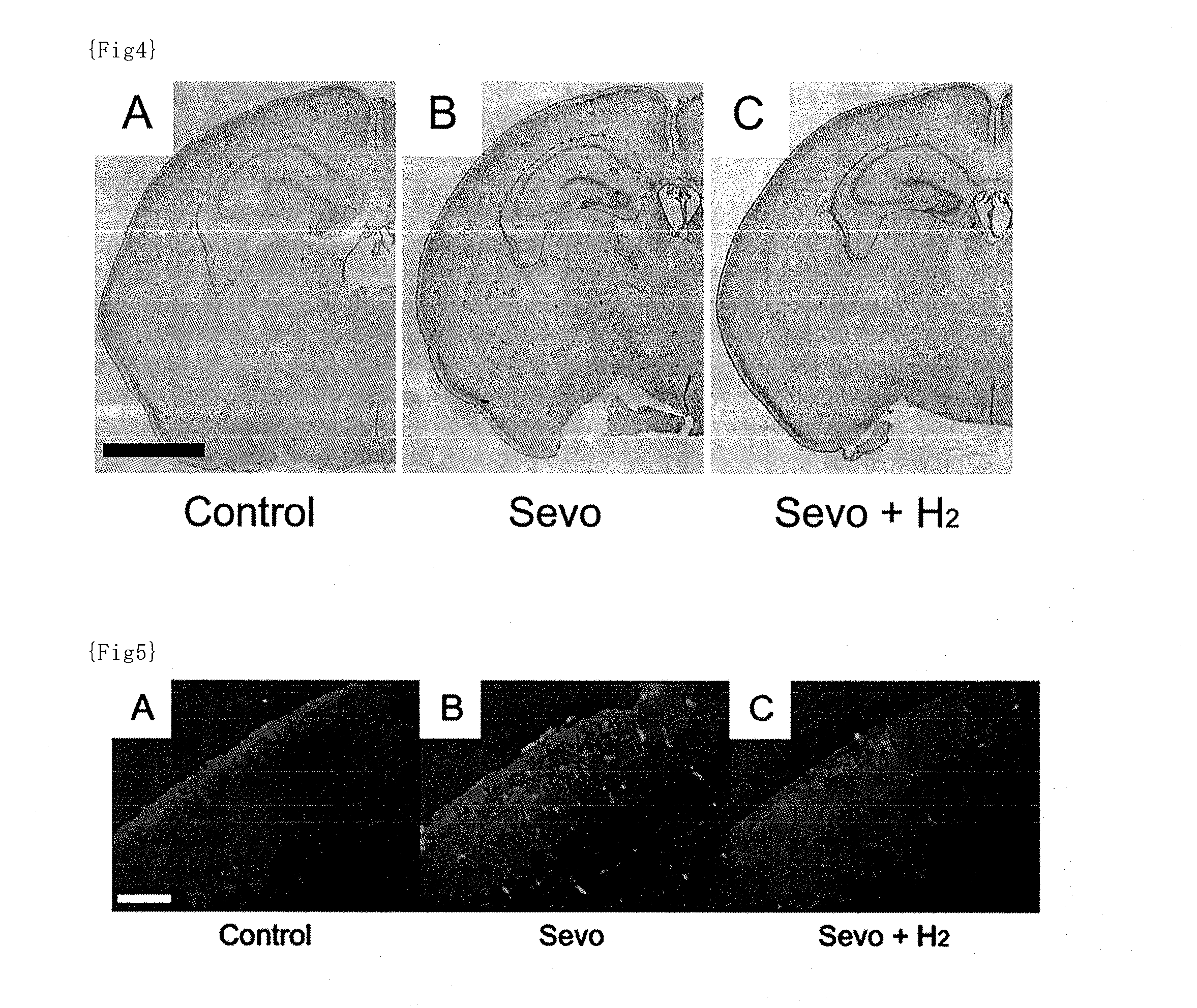 Medicine comprising combination of general anesthetic and hydrogen