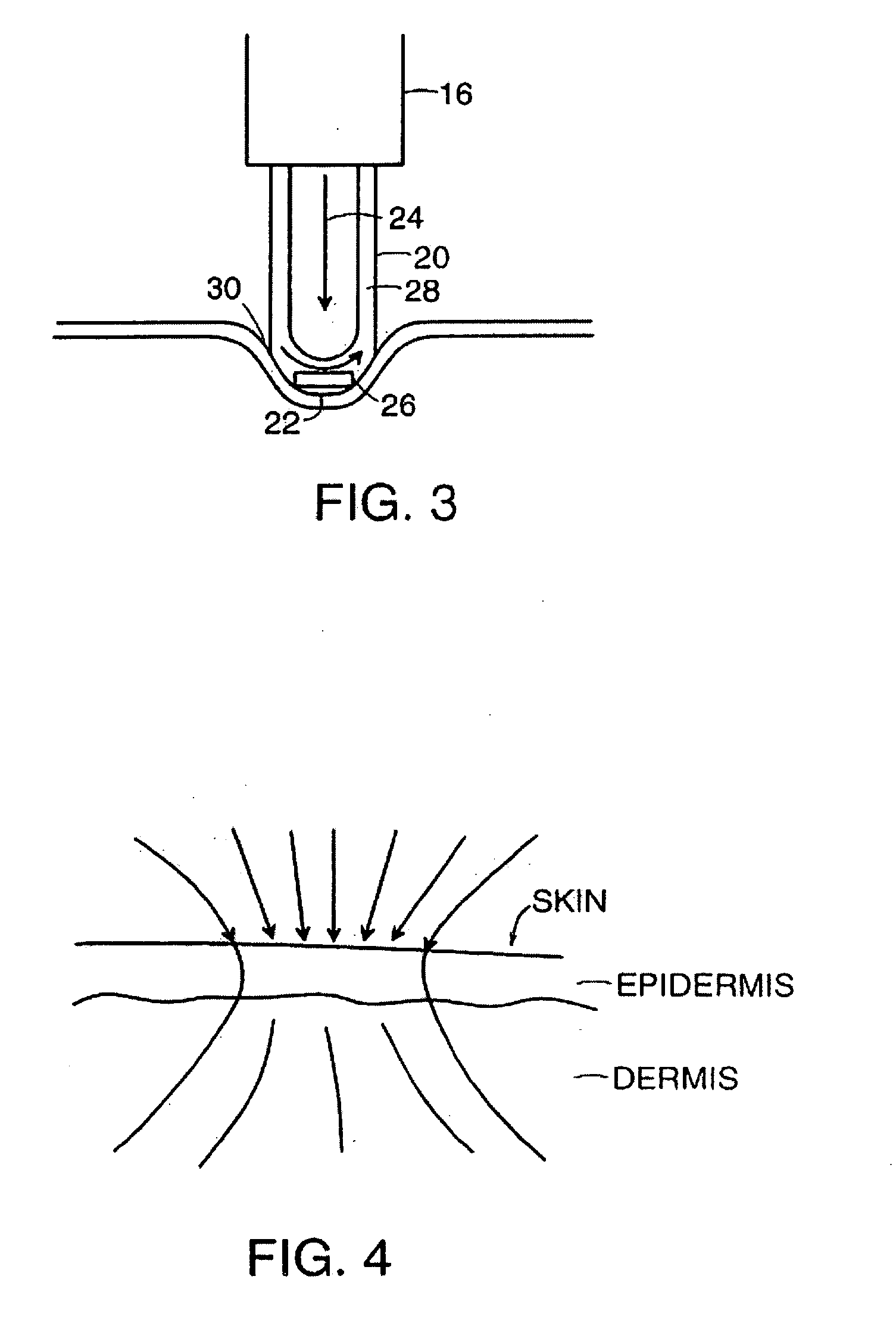 Method and apparatus for treating wrinkles in skin using radiation