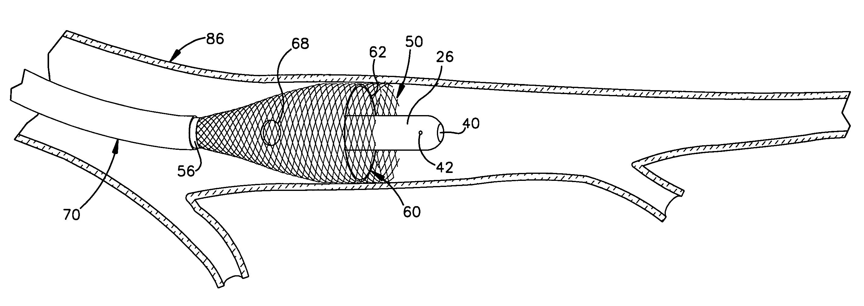 Apparatus for auto-retroperfusion of a coronary vein