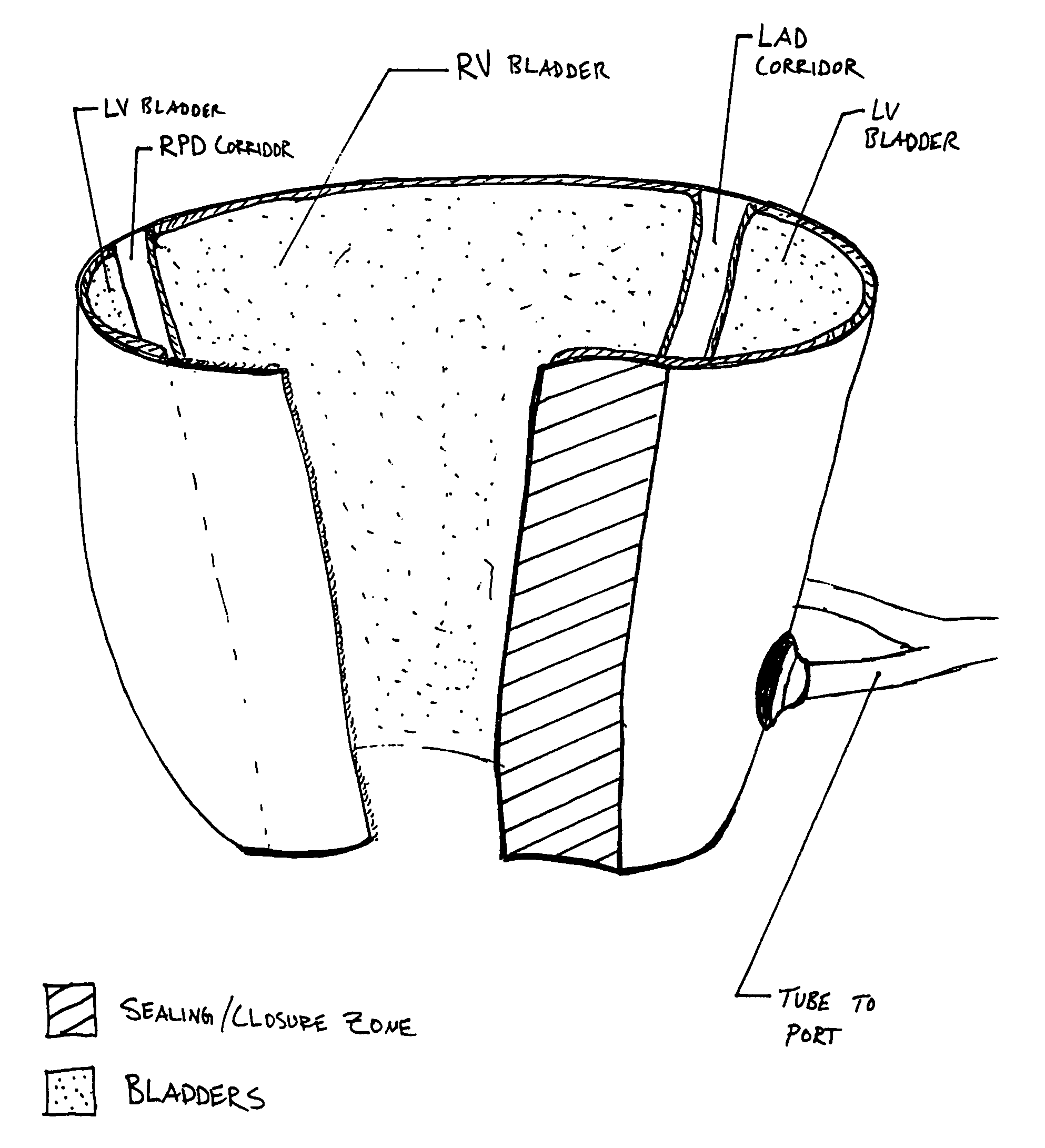 Progressive biventricular diastolic support device