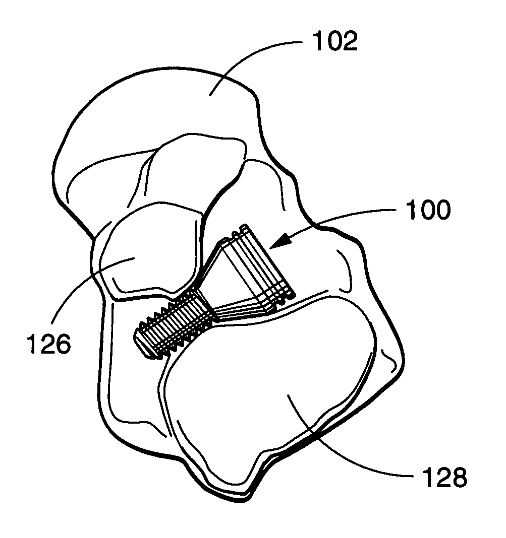 Sinus tarsi implant