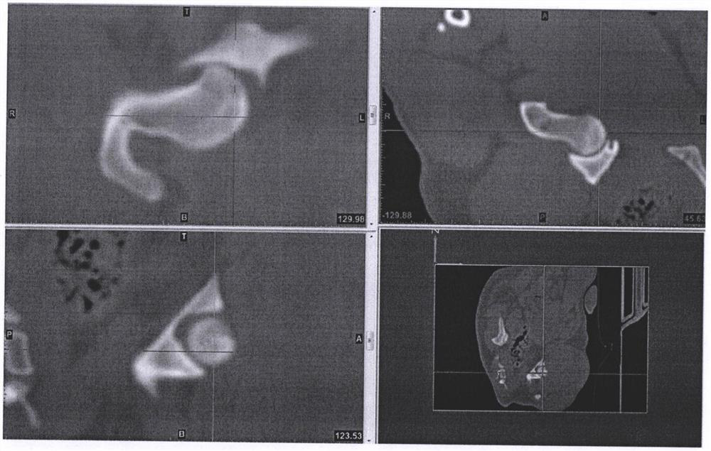 3D printed femoral head necrosis navigation template and construction method thereof and use of navigation template and construction method