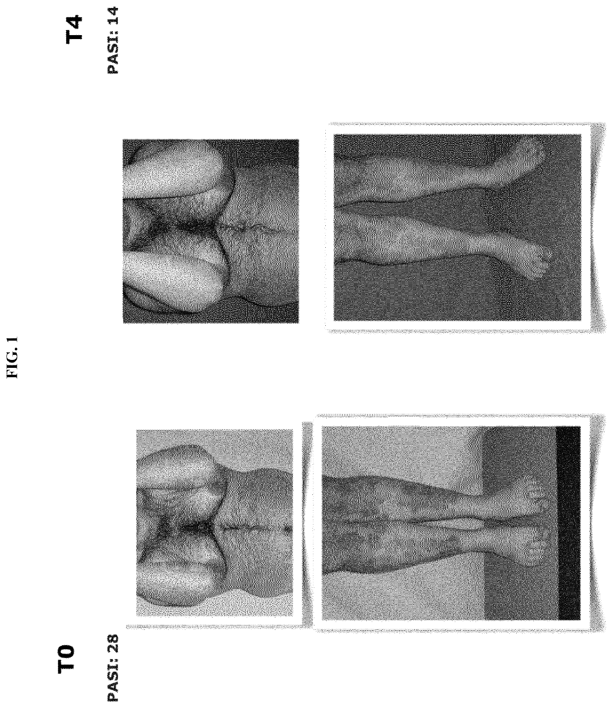 Probiotic for the treatment of psoriasis