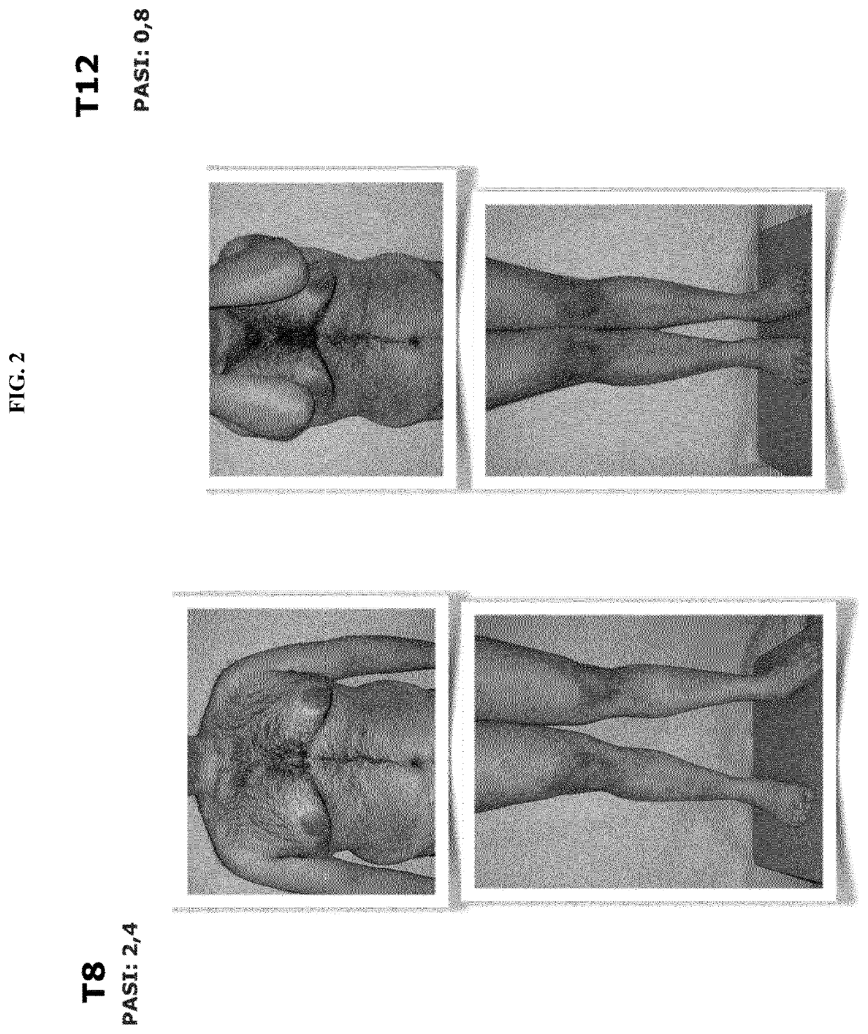 Probiotic for the treatment of psoriasis