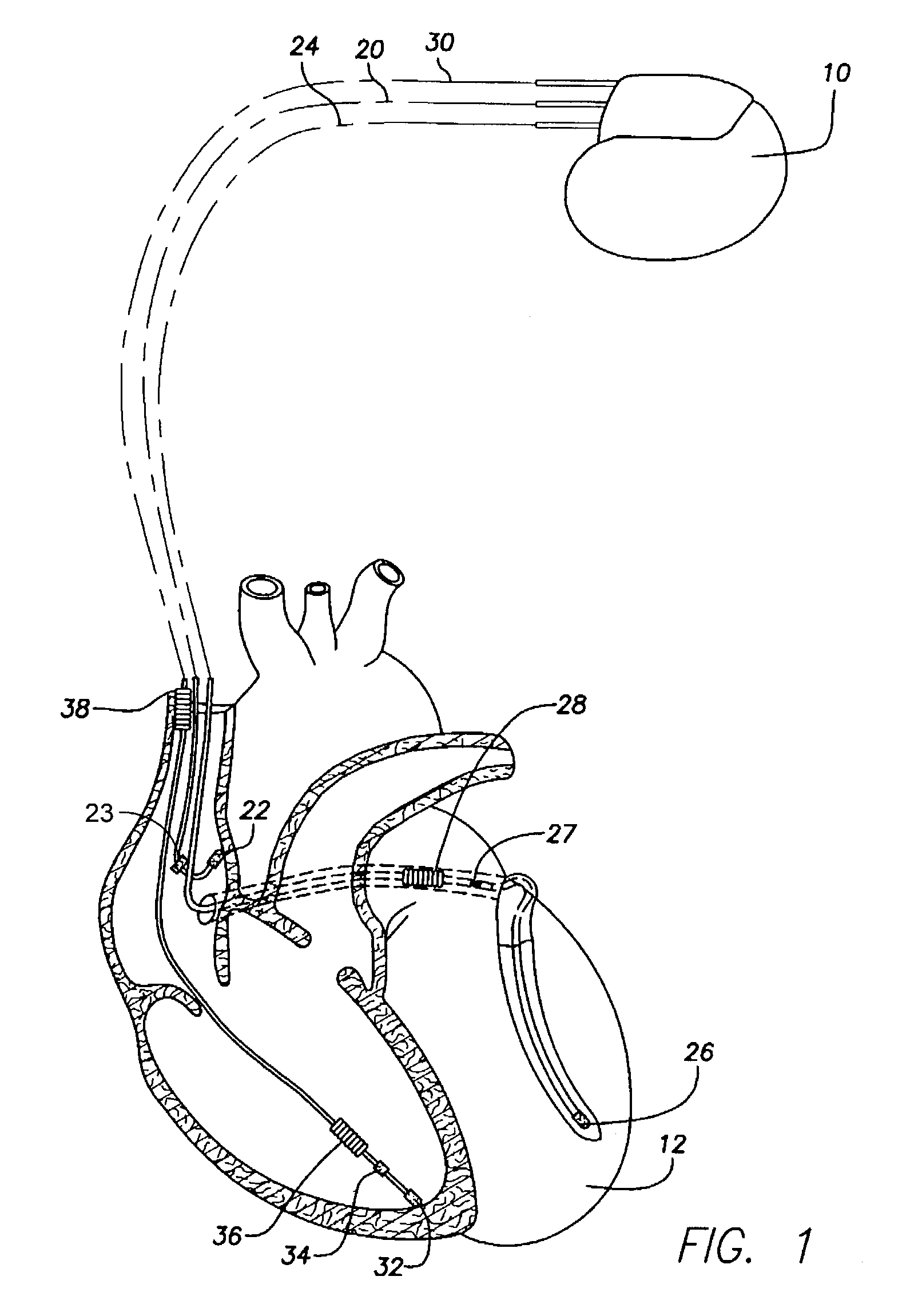 System and method for providing cardioversion therapy and overdrive pacing using an implantable cardiac stimulation device