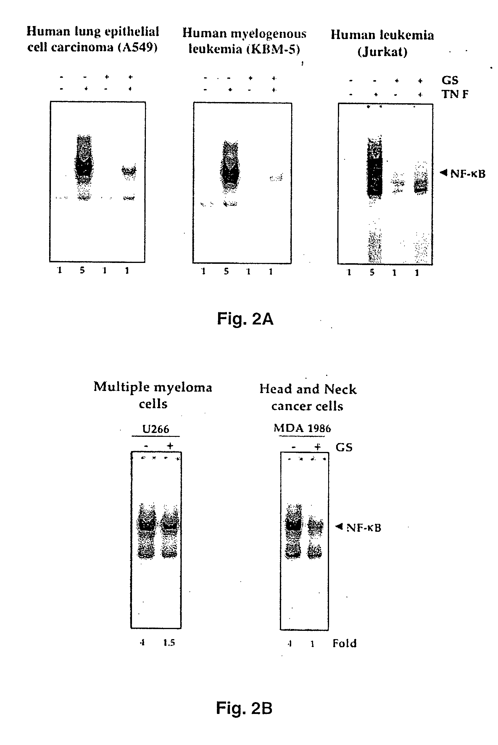 Guggulsterone: an inhibitor of nuclear factor - kappaB and IkappaBalpha kinase activation and uses thereof