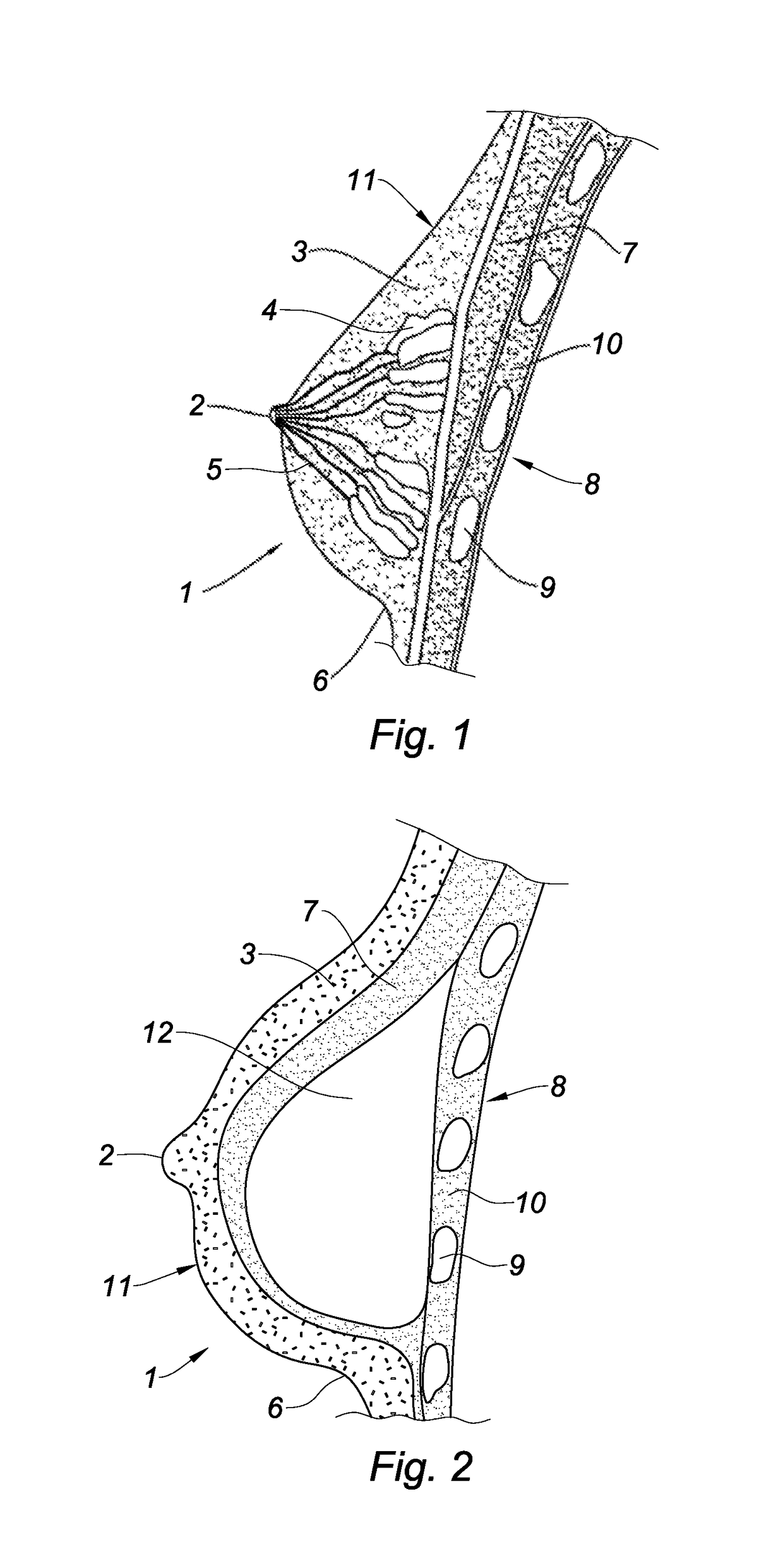 Prosthesis for supporting a breast structure