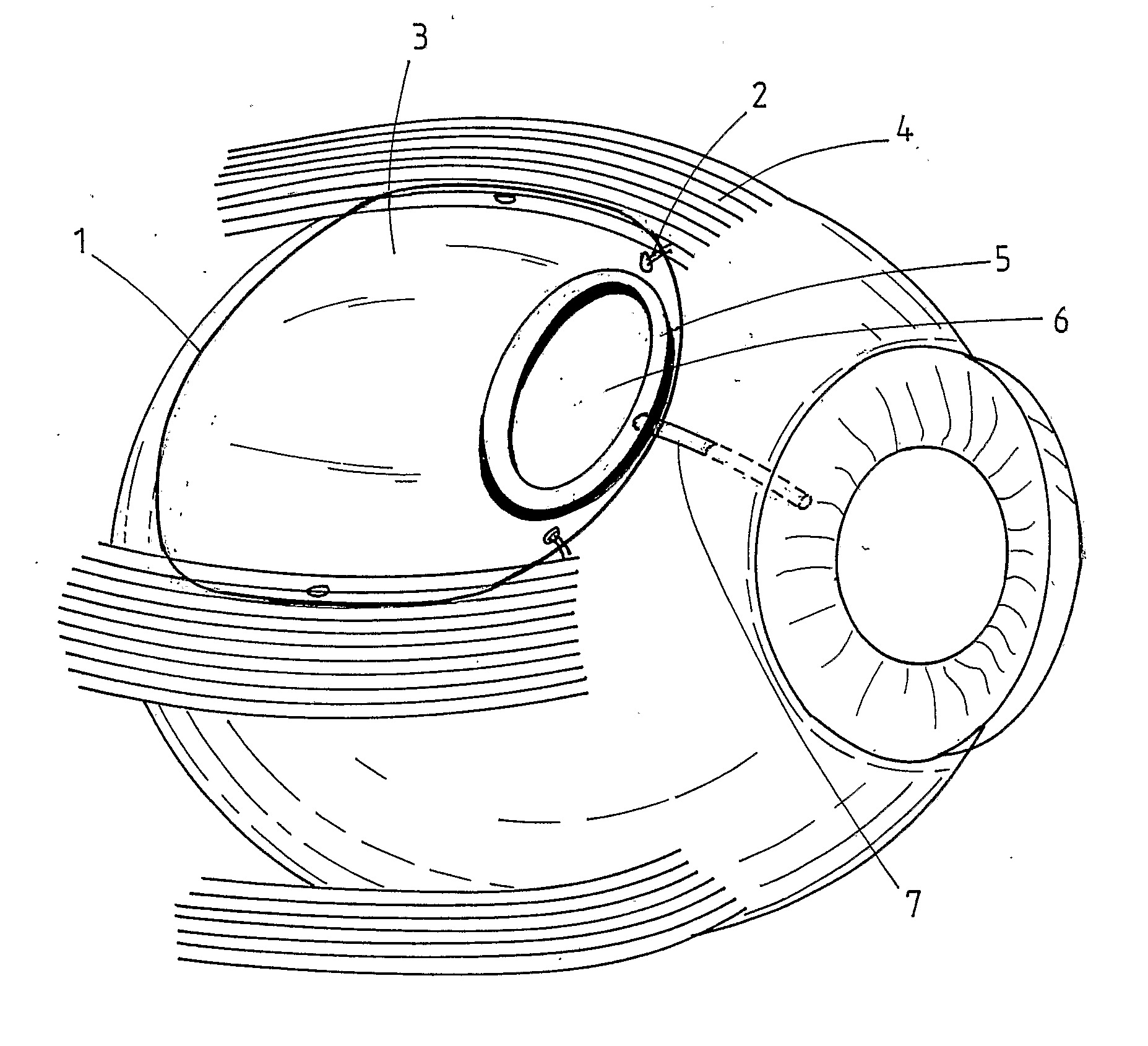 Ophthalmic Implant for Treating Glaucoma