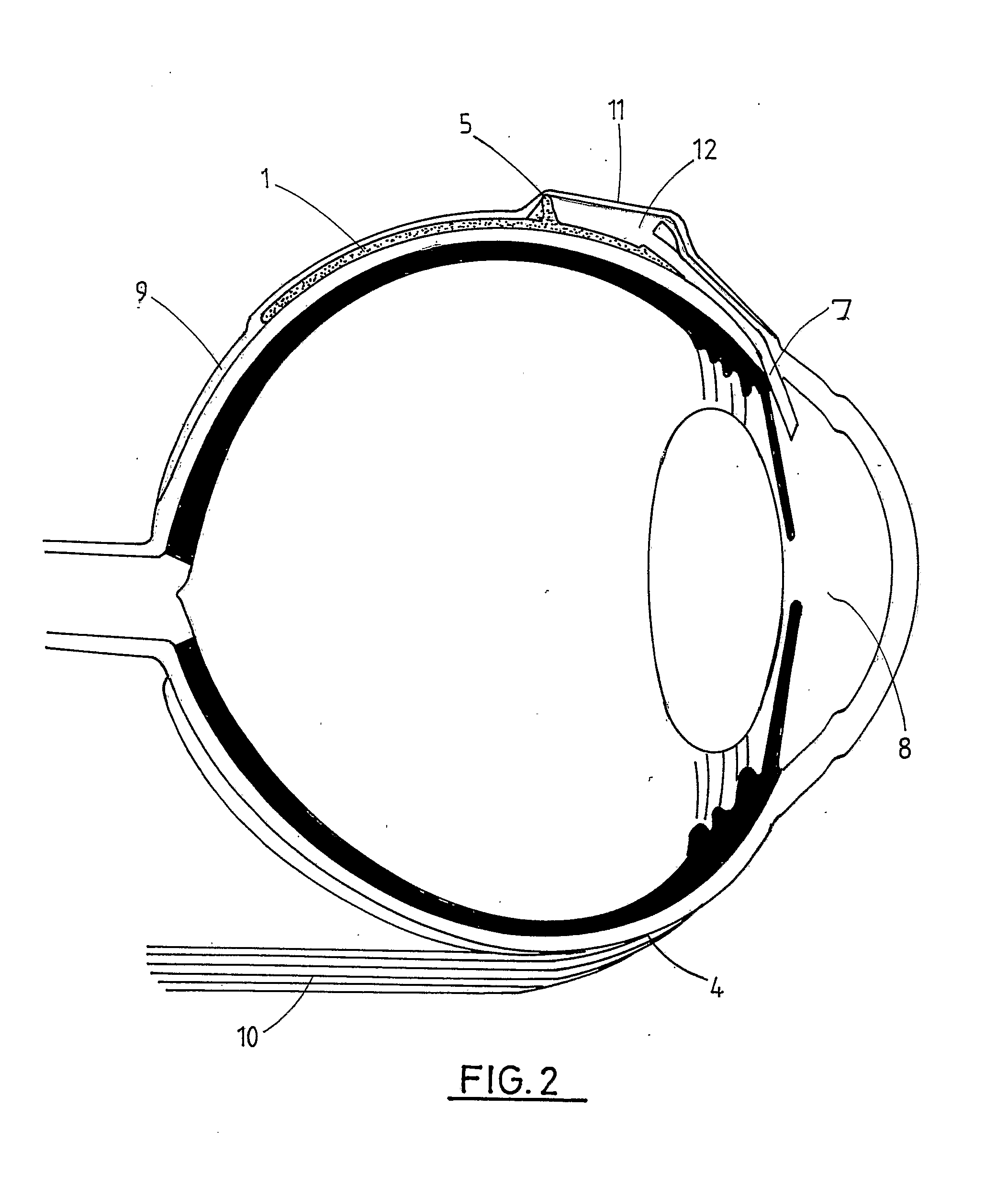 Ophthalmic Implant for Treating Glaucoma